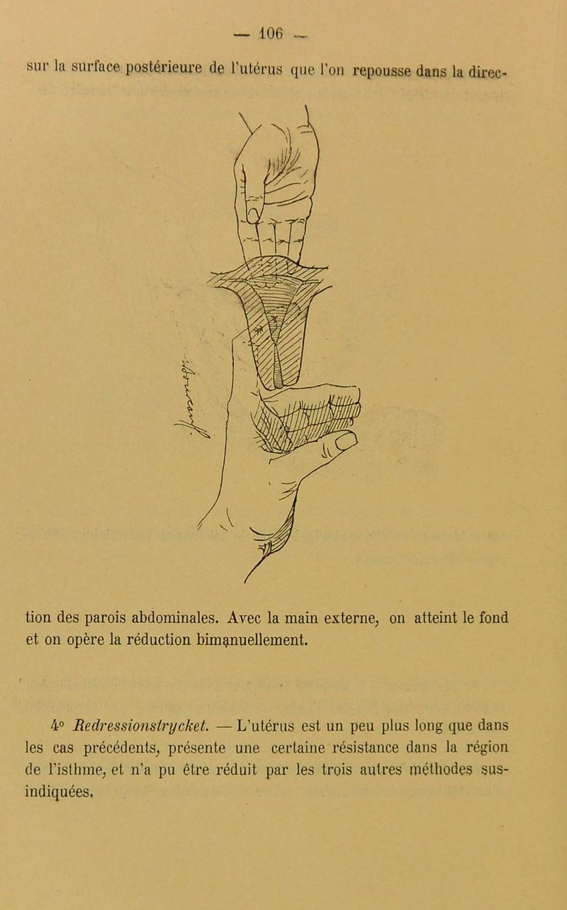 sur la surface postérieure de Tutérus que l’on repousse dans la direc- tion des parois abdominales. Avec la main externe, on atteint le fond et on opère la réduction bimanuellement. 4° Redressionstrycket. — L’utérus est un peu plus long que dans les cas précédents, présente une certaine résistance dans la région de l’isthme, et n’a pu être réduit par les trois autres méthodes sus- indiquées.