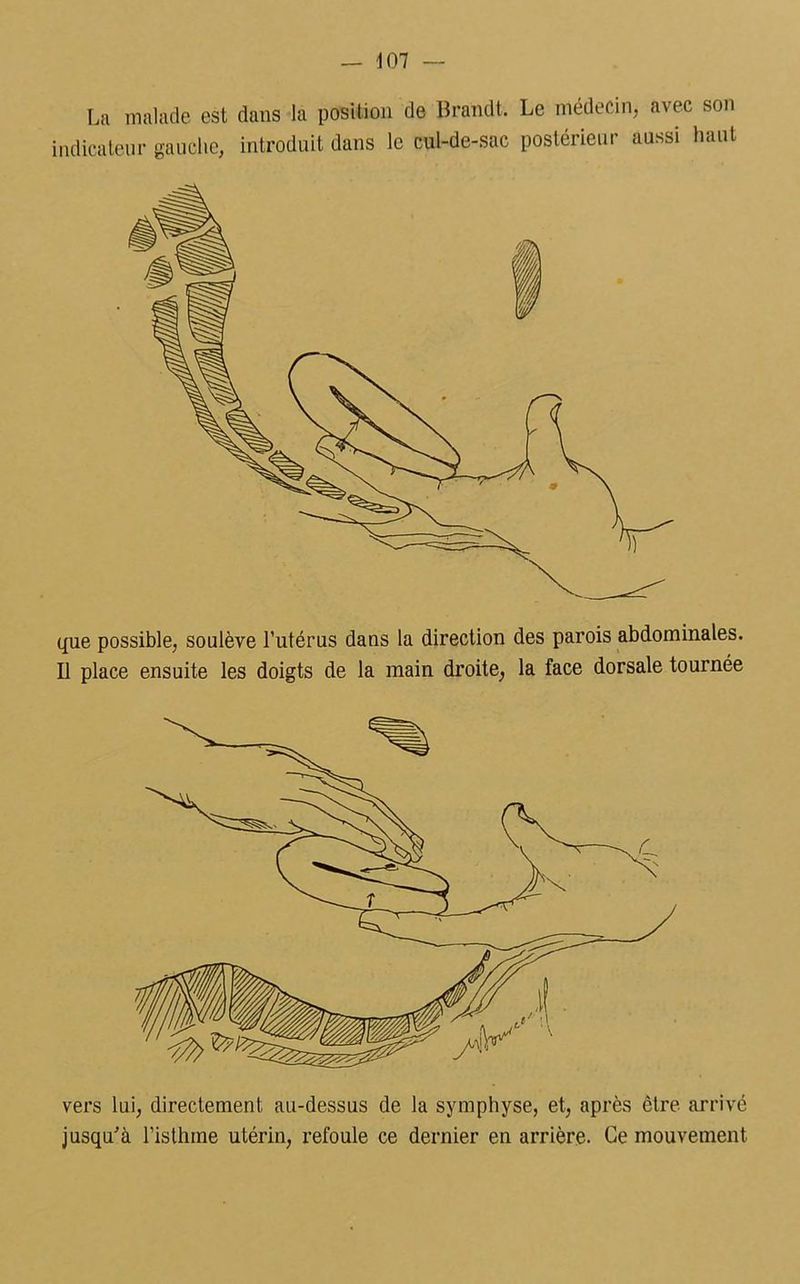 La malade est dans la position de Brandt. Le médecin, avec son indicateur gauche, introduit dans le cul-de-sac postérieur aussi haut que possible, soulève l’utérus dans la direction des parois abdominales. Il place ensuite les doigts de la main droite, la face dorsale tournée vers lui, directement au-dessus de la symphyse, et, après être arrivé jusqu'à l’isthme utérin, refoule ce dernier en arrière. Ce mouvement