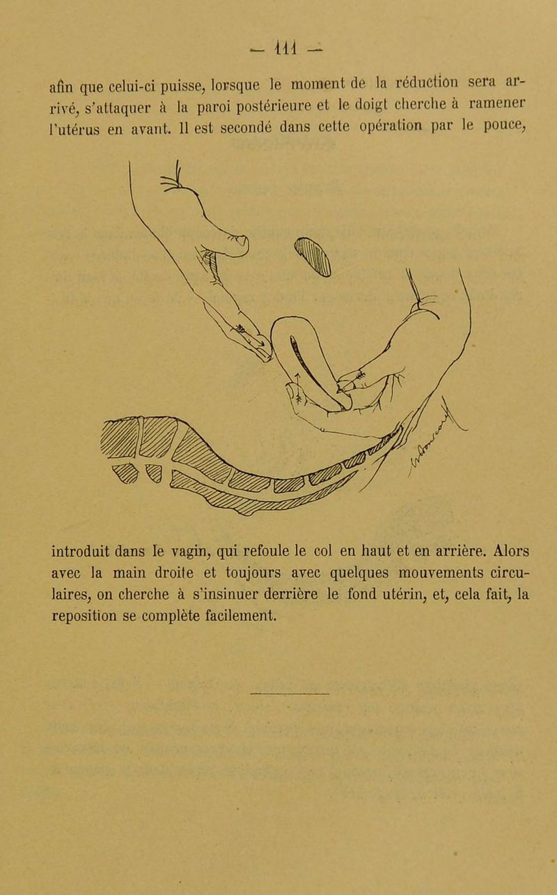afin que celui-ci puisse, lorsque le moment de la réduction sera ar- rivé, s'attaquer à la paroi postérieure et le doigt cherche à ramenei l'utérus en avant. 11 est secondé dans cette opération par le pouce, introduit dans le vagin, qui refoule le col en haut et en arrière. Alors avec la main droite et toujours avec quelques mouvements circu- laires, on cherche à s’insinuer derrière le fond utérin, et, cela fait, la reposition se complète facilement.
