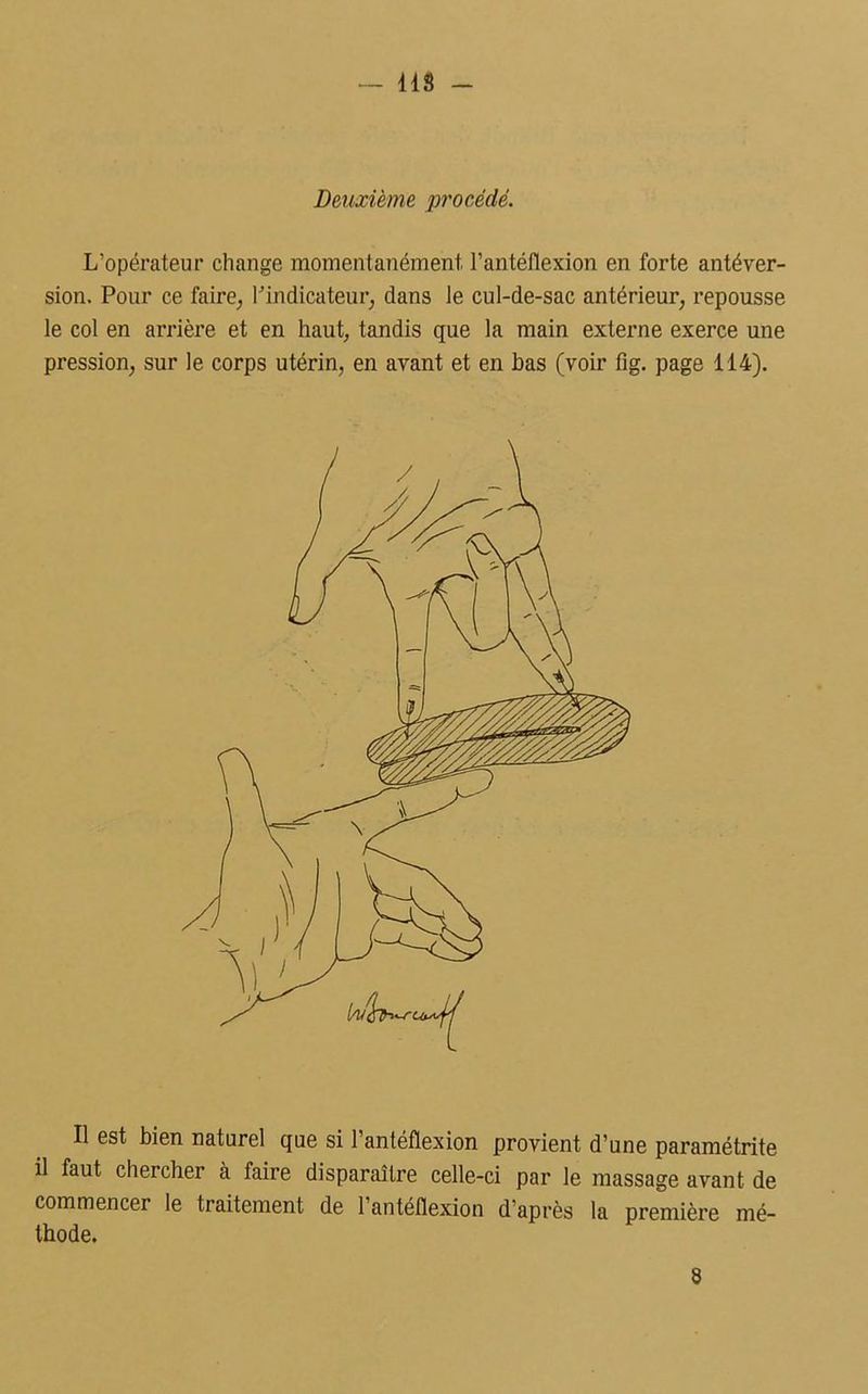 lis - Deuxième procédé. L'opérateur change momentanément l’antéflexion en forte antéver- sion. Pour ce faire, l'indicateur, dans le cul-de-sac antérieur, repousse le col en arrière et en haut, tandis que la main externe exerce une pression, sur le corps utérin, en avant et en bas (voir lîg. page 114). Il est bien naturel que si 1 antéfïexion provient d’une paramétrite il faut chercher à faire disparaître celle-ci par le massage avant de commencer le traitement de l’antéflexion d'après la première mé- thode. 8