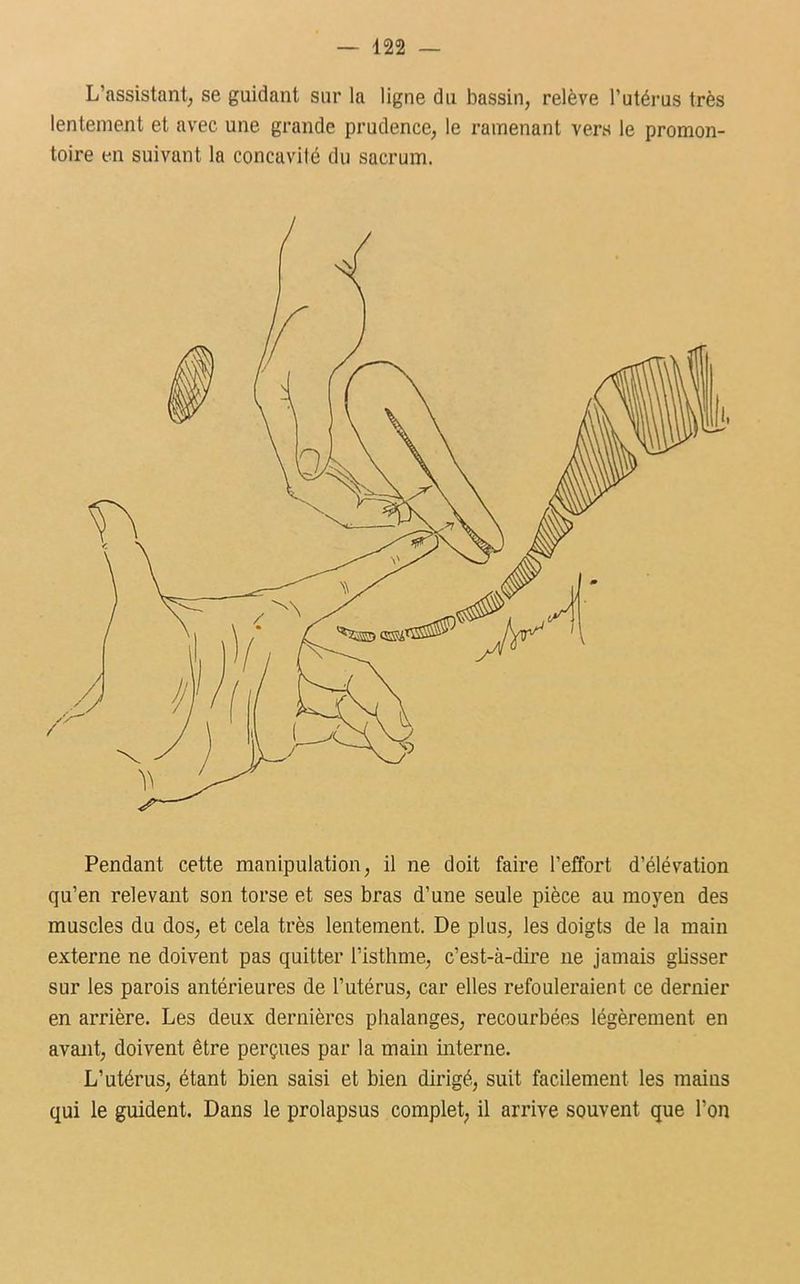 L’assistant; se guidant sur la ligne du bassin, relève l’utérus très lentement et avec une grande prudence, le ramenant vers le promon- toire en suivant la concavité du sacrum. Pendant cette manipulation, il ne doit faire l’effort d’élévation qu’en relevant son torse et ses bras d’une seule pièce au moyen des muscles du dos, et cela très lentement. De plus, les doigts de la main externe ne doivent pas quitter l’isthme, c’est-à-dire ne jamais glisser sur les parois antérieures de l’utérus, car elles refouleraient ce dernier en arrière. Les deux dernières phalanges, recourbées légèrement en avant, doivent être perçues par la main interne. L’utérus, étant bien saisi et bien dirigé, suit facilement les mains qui le guident. Dans le prolapsus complet, il arrive souvent que l’on