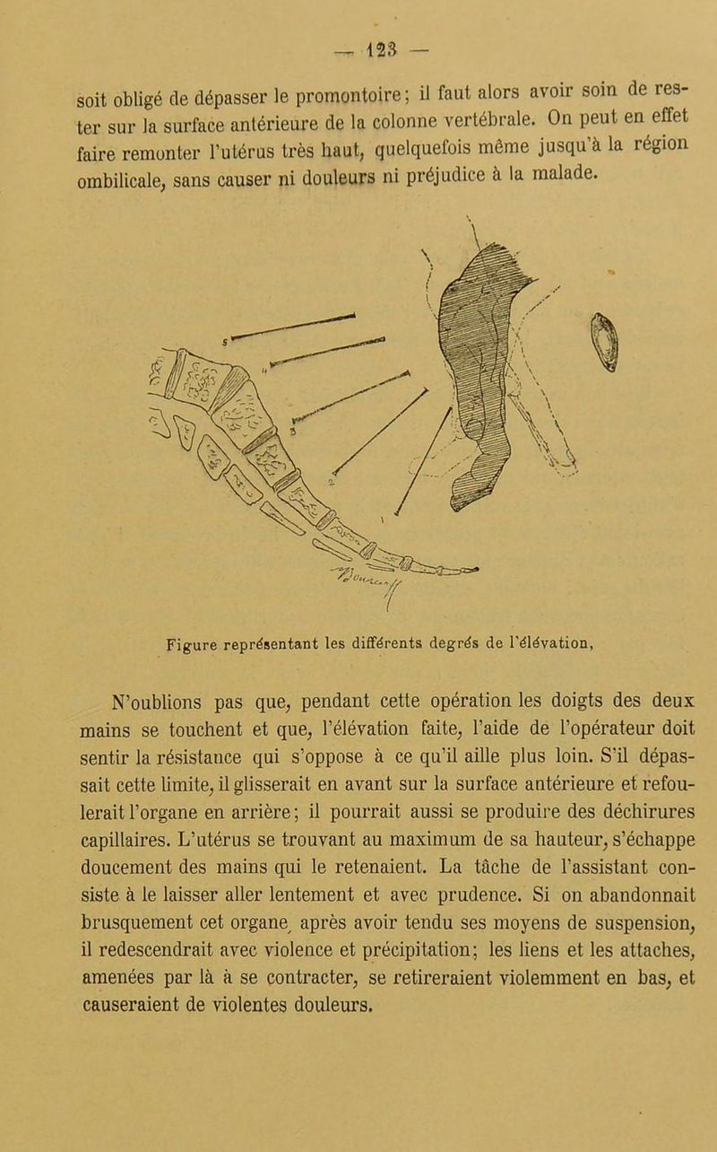 soit obligé de dépasser le promontoire; il faut alors avoir soin de res- ter sur la surface antérieure de la colonne vertébrale. On peut en effet faire remonter l’utérus très haut, quelquefois môme jusqu’à la région ombilicale, sans causer ni douleurs ni préjudice à la malade. N’oublions pas que, pendant cette opération les doigts des deux mains se touchent et que, l’élévation faite, l’aide de l’opérateur doit sentir la résistance qui s’oppose à ce qu’il aille plus loin. S'il dépas- sait cette limite, il glisserait en avant sur la surface antérieure et refou- lerait l’organe en arrière ; il pourrait aussi se produire des déchirures capillaires. L’utérus se trouvant au maximum de sa hauteur, s’échappe doucement des mains qui le retenaient. La tâche de l’assistant con- siste à le laisser aller lentement et avec prudence. Si on abandonnait brusquement cet organe, après avoir tendu ses moyens de suspension, il redescendrait avec violence et précipitation; les liens et les attaches, amenées par là à se contracter, se retireraient violemment en bas, et causeraient de violentes douleurs.