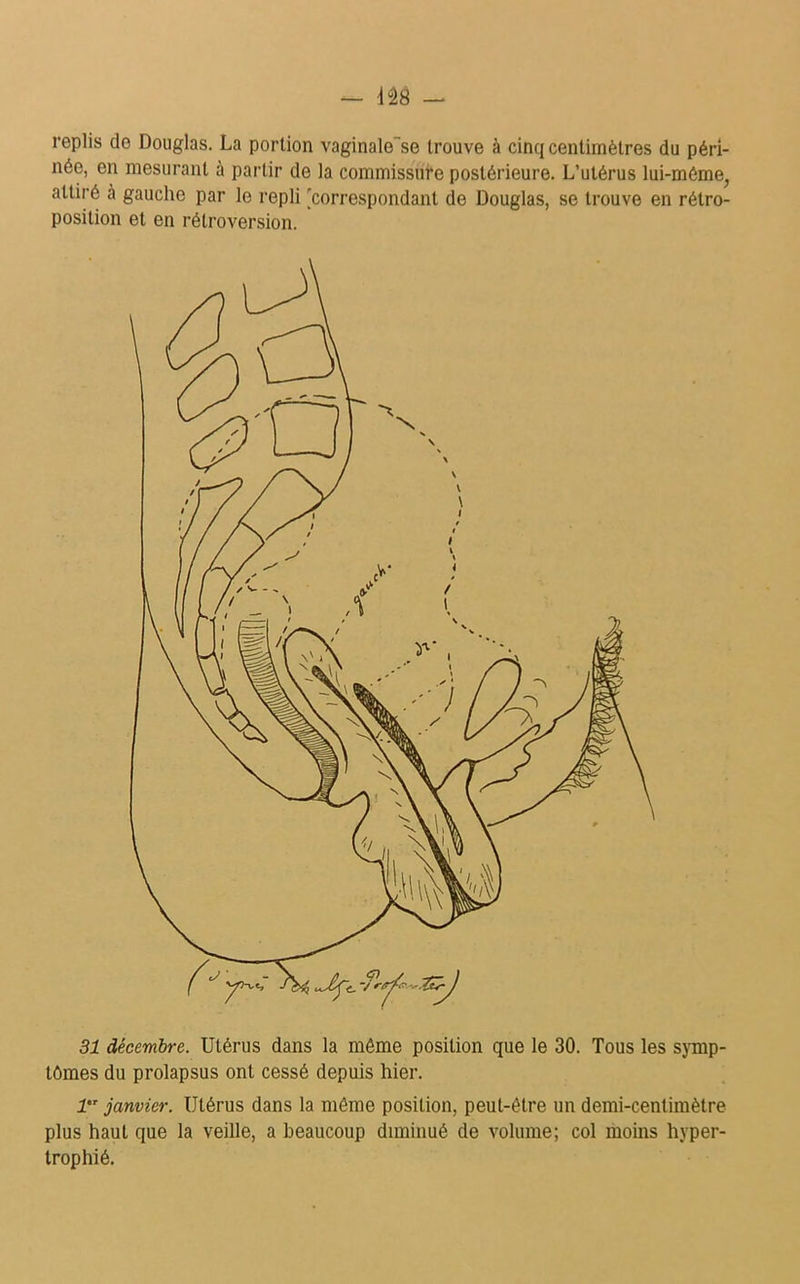 replis do Douglas. La portion vaginale~se trouve à cinq centimètres du péri- née, en mesurant à partir de la commissure postérieure. L’utérus lui-même, attiré à gaucho par le repli [correspondant de Douglas, se trouve en rétro- position et en rétroversion. 31 décembre. Utérus dans la même position que le 30. Tous les symp- tômes du prolapsus ont cessé depuis hier. 1,T janvier. Utérus dans la même position, peut-être un demi-centimètre plus haut que la veille, a beaucoup diminué de volume; col moins hyper- trophié.