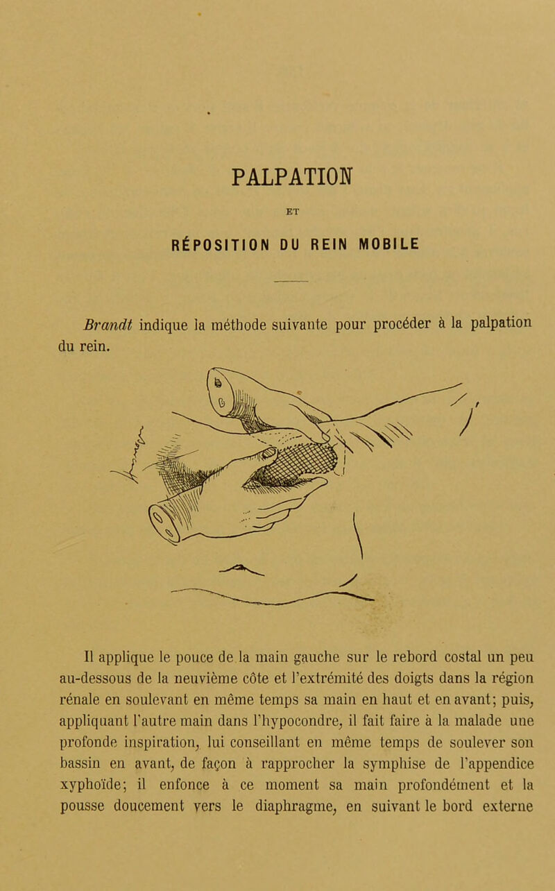 ET RÉPOSITION DU REIN MOBILE Brandt indique ia méthode suivante pour procéder à la palpation du rein. Il applique le pouce de la main gauche sur le rebord costal un peu au-dessous de la neuvième côte et l’extrémité des doigts dans la région rénale en soulevant en même temps sa main en haut et en avant; puis, appliquant l'autre main dans l’hypocondre, il fait faire à la malade une profonde inspiration, lui conseillant en même temps de soulever son bassin en avant, de façon à rapprocher la symphise de l'appendice xyphoïde; il enfonce à ce moment sa main profondément et la pousse doucement vers le diaphragme, en suivant le bord externe