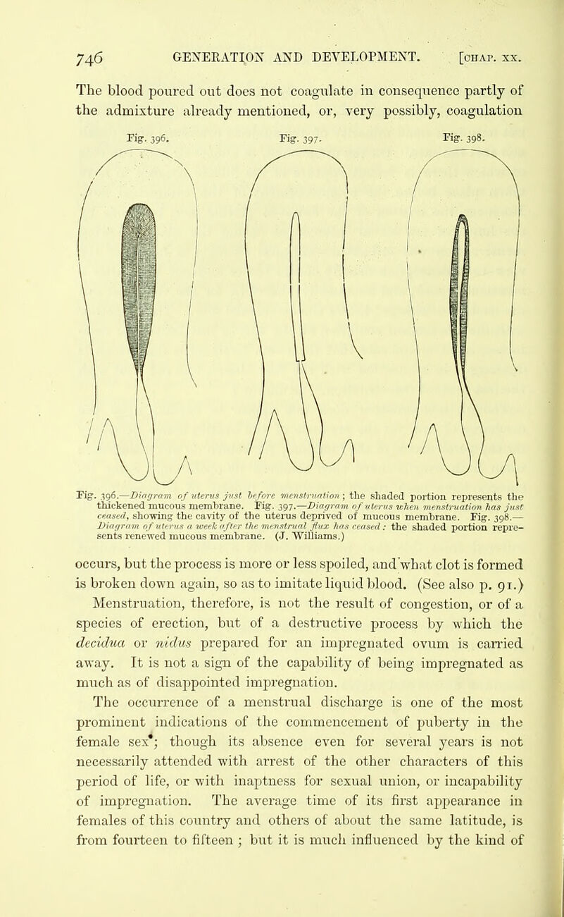 The blood poured out does not coagulate in consequence partly of the admixture already mentioned, or, veiy possibly, coagulation Tig. 396. Fig. 397- Fig:. 398. Pig^. 396.—Diriijram of vtervs jvst hefnre mriistnintloii; the shaded portion represents the thickened mucous membrane. Fig. 397.—Diar/rmn nfvtfnis when menstruation has jnst ceased, showing the cavity of the uteiTJS deprived of mucous membrane. Fig. 398.— Vmgrtnn of uterus a week nfter the menstrual Jinx has ceased: the shaded portion repre- sents renewed mucous membrane. (J. Williams.) occurs, but the process is more or less spoiled, and'what clot is formed is broken down again, so as to imitate liquid blood. (See also }). 91.) Menstruation, therefore, is not the result of congestion, or of a species of erection, but of a destructive process by which the decidua or nidus prepared for an impregnated ovum is carried away. It is not a sign of the capability of being impregnated as much as of disappointed impi'egnation. The occurrence of a menstrual discharge is one of the most prominent indications of the commencement of puberty in the female sex'; though its absence even for several years is not necessarily attended with arrest of the other characters of this period of life, or with inaptness for sexual union, or incapability of impregnation. The average time of its first appearance in females of this country and others of about the same latitude, is from fourteen to fifteen ; but it is much influenced by the kind of