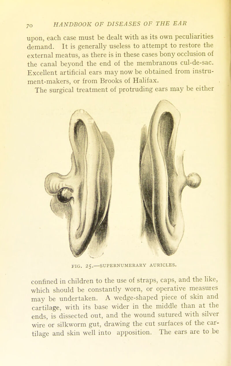upon, each case must be dealt with as its own pecuHarities demand. It is generally useless to attempt to restore the external meatus, as there is in these cases bony occlusion of the canal beyond the end of the membranous cul-de-sac. Excellent artificial ears may now be obtained from instru- ment-makers, or from Brooks of Halifax. The surgical treatment of protruding ears may be either FIG. 25. SUPERNUMERARY AURICLES. confined in children to the use of straps, caps, and the like, which should be constantly worn, or operative measures may be undertaken. A wedge-shaped piece of skin and cartilage, with its base wider in the middle than at the ends, is dissected out, and the wound sutured with silver wire or silkworm gut, drawing the cut surfaces of the car- tilage and skin well into apposition. The ears are to be