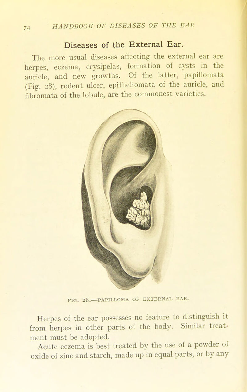 Diseases of the External Ear. The more usual diseases affecting the external ear are herpes, eczema, erysipelas, formation of cysts in the auricle, and new growths. Of the latter, papillomata (Fig. 28), rodent ulcer, epitheliomata of the auricle, and fibromata of the lobule, are the commonest varieties. FIG. 28. PAPILLOMA OF EXTERNAL EAR. Herpes of the ear possesses no featiure to distinguish it from herpes in other parts of the body. Similar treat- ment must be adopted. Acute eczema is best treated by the use of a powder of oxide of zinc and starch, made up in equal parts, or by any
