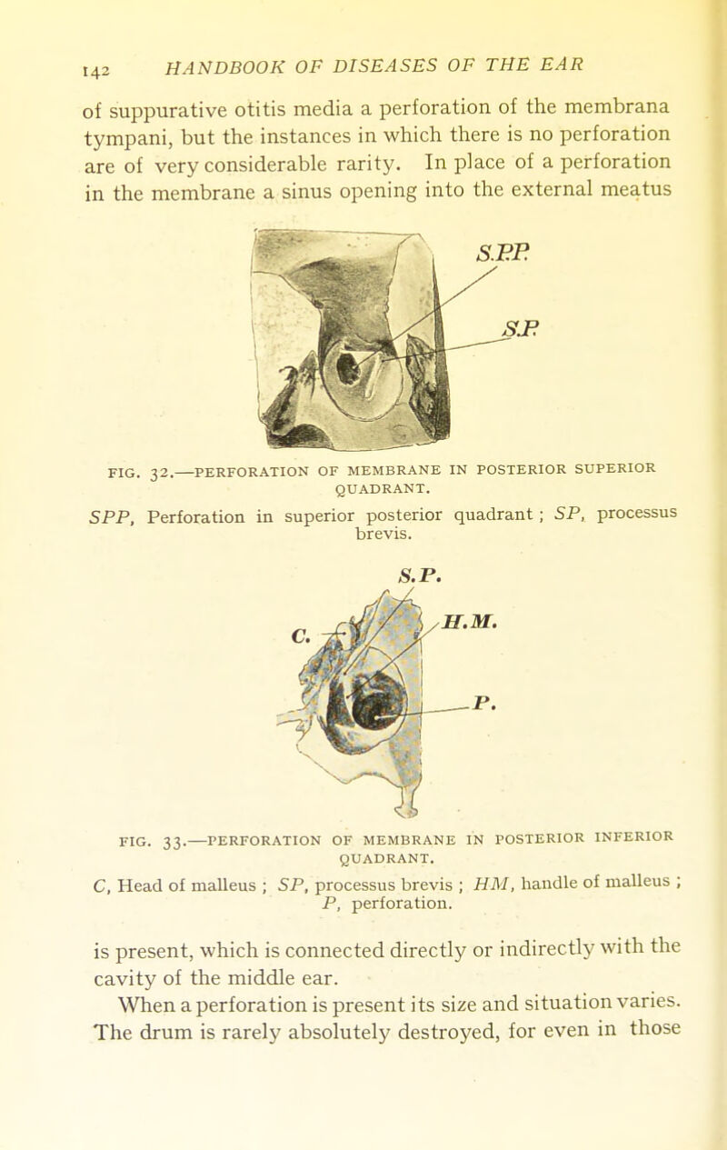 of suppurative otitis media a perforation of the membrana tympani, but the instances in which there is no perforation are of very considerable rarity. In place of a perforation in the membrane a sinus opening into the external meatus FIG. 32. PERFORATION OF MEMBRANE IN POSTERIOR SUPERIOR QUADRANT. SPP, Perforation in superior posterior quadrant; SP, processus brevis. S.P. FIG. 33. PERFORATION OF MEMBRANE IN POSTERIOR INFERIOR QUADRANT. C, Head of malleus ; SP, processus brevis ; HM, handle of malleus ; P, perforation. is present, which is connected directly or indirectly with the cavity of the middle ear. When a perforation is present its size and situation varies. The drum is rarely absolutely destroyed, for even in those