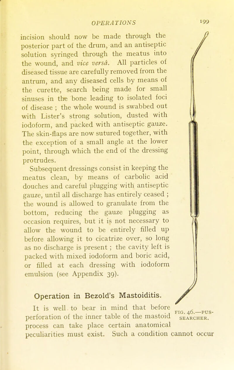 incision should now be made through the posterior part of the drum, and an antiseptic / solution syringed through the meatus into / the wound, and vice versa. All particles of jf diseased tissue are carefully removed from the | antrum, and any diseased cells by means of | the curette, search being made for small I sinuses in the bone leading to isolated foci | of disease ; the whole wound is swabbed out 11 with Lister's strong solution, dusted with i iodoform, and packed with antiseptic gauze. ff^l The skin-flaps are now sutured together, with , I the exception of a small angle at the lower |l point, through which the end of the dressing I protrudes. I I Subsequent dressings consist in keeping the | I meatus clean, by means of carboHc acid i l douches and careful plugging with antiseptic 11 gauze, until all discharge has entirely ceased ; III the wound is allowed to granulate from the 11 bottom, reducing the gauze plugging as 11 occasion requires, but it is not necessary to IK allow the wound to be entirely filled up 1| before allowing it to cicatrize over, so long | as no discharge is present; the cavity left is j packed with mixed iodoform and boric acid, I or filled at each dressing with iodoform j emulsion (see Appendix 39). j Operation in Bezold's Mastoiditis. It is well to bear in mind that before ^ , . , , r ji i. • 1 FIG-46.—PUS- perforation of the mner table of the mastoid searcher. process can take place certain anatomical pecuharities must exist. Such a condition cannot occur