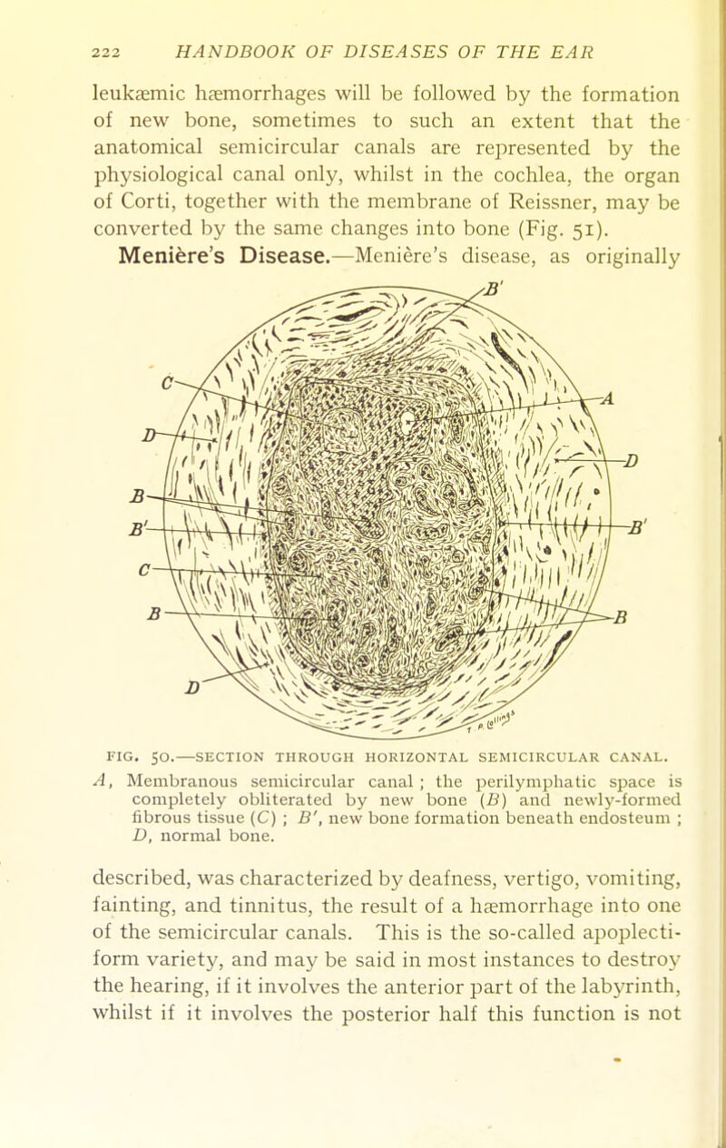 leukaemic hjemorrhages will be followed by the formation of new bone, sometimes to such an extent that the anatomical semicircular canals are represented by the physiological canal only, whilst in the cochlea, the organ of Corti, together with the membrane of Reissner, may be converted by the same changes into bone (Fig. 51). Meniere's Disease.—Meniere's disease, as originally FIG. 50. SECTION THROUGH HORIZONTAL SEMICIRCULAR CANAL. A, Membranous semicircular canal ; the perilymphatic space is completely obliterated by new bone (B) and newly-formed tibrous tissue (C) ; B', new bone formation beneath endosteum ; D, normal bone. described, was characterized by deafness, vertigo, vomiting, fainting, and tinnitus, the result of a hasmorrhage into one of the semicircular canals. This is the so-called apoplecti- form variety, and may be said in most instances to destro}^ the hearing, if it involves the anterior part of the labyrinth, whilst if it involves the posterior half this function is not