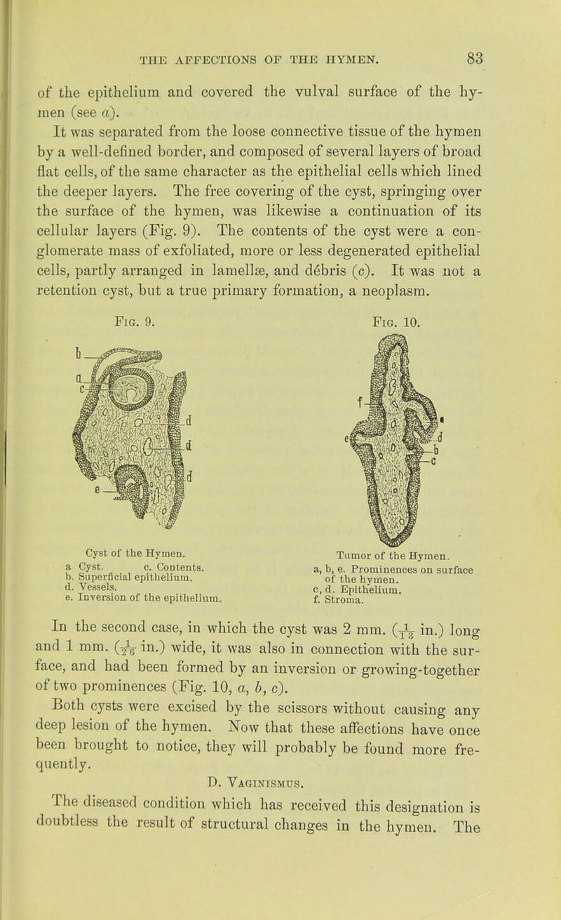 of the epithelium and covered the vulval surface of the hy- men (see a). It was separated from the loose connective tissue of the hymen by a well-defined border, and composed of several layers of broad flat cells, of the same character as the epithelial cells which lined the deeper layers. The free covering of the cyst, springing over the surface of the hymen, was likewise a continuation of its cellular layers (Fig. 9). The contents of the cyst were a con- glomerate mass of exfoliated, more or less degenerated epithelial cells, partly arranged in lamellse, and debris (c). It was not a retention cyst, but a true primary formation, a neoplasm. Fig. 9. Fig. 10. Cyst of the Hymen. a Cyst. c. Contents, b. Superficial epithelium. d. Vessels. e. Inversion of the epithelium. Tumor of the Hymen. a, b, e. Prominences on surface of the hymen, c, d. Epithelium, f. Stroma. In the second case, in which the cyst was 2 mm. (^ in.) long and 1 mm. (-^ in.) wide, it was also in connection with the sur- face, and had been formed by an inversion or growing-together of two prominences (Fig. 10, a, b, c). Both cysts were excised by the scissors without causing any deep lesion of the hymen. Now that these affections have once been brought to notice, they will probably be found more fre- quently. D. Vaginismus. The diseased condition which has received this designation is doubtless the result of structural changes in the hymen. The