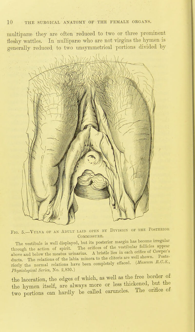 multiparas they are often reduced to two or tliree prominent ilesliy wattles. In nulliparfe who are not virgins the hymen is generally reduced to two unsymmetrical portions divided hy IiG. 5.-VUI.VA OF AN Adult laid open by Division of the Posteriou Commissure. Tlie vestibule is well displayed, but its posterior margin has become irregular through the action of spirit. The orifices of the vestibular fomcles appear above and below the meatus urinarius. A bristle lies m each orifice of Co^^pe. s ducts. The relations of the labia minora to the clitoris are well shown. Poste- riorly the normal relations have been completely effaced. {Museum Jt.C.S., Physiological Scries, No. 2,830.) the laceration, the edges of which, as weU as the free ^or^f the hymen itself, are always more or less thickened, but the two portions can hardly be caUed caruncles. The onfice of