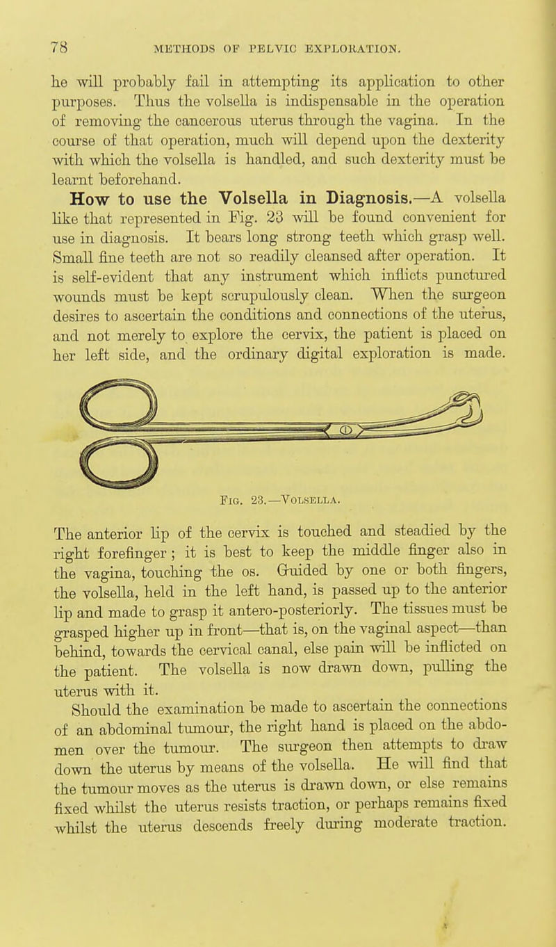 he will probably fail in attempting its application to other purposes. Thus the volsella is indispensable in the operation of removing the cancerous uterus through the vagina. In the course of that operation, much will depend upon the dexterity with which the volsella is handled, and such dexterity must be learnt beforehand. How to use the Volsella in Diagnosis.—A volsella like that represented in Fig. 23 will be found convenient for use in diagnosis. It bears long strong teeth which grasp well. Small fine teeth are not so readily cleansed after operation. It is self-evident that any instrument which inflicts punctured wounds must be kept scrupulously clean. When the surgeon desii-es to ascertain the conditions and connections of the uterus, and not merely to explore the cervix, the patient is placed on her left side, and the ordinary digital exploration is made. Fig. 23.—Volsella. The anterior hp of the cervix is touched and steadied by the right forefinger ; it is best to keep the middle finger also in the vagina, touching the os. Gruided by one or both fingers, the volseUa, held in the left hand, is passed up to the anterior lip and made to grasp it antero-posteriorly. The tissues must be grasped higher up in front—that is, on the vaginal aspect—than behind, towards the cervical canal, else pain wiU be inflicted on the patient. The volsella is now drawn down, pulling the uterus with it. Should the examination be made to ascertain the connections of an abdominal tumour, the right hand is placed on the abdo- men over the tumour. The surgeon then attempts to di-aw down the uterus by means of the volseUa. He will find that the tumour moves as the uterus is drawn down, or else remains fixed whilst the uterus resists traction, or perhaps remains fixed whilst the uterus descends freely dming moderate traction.