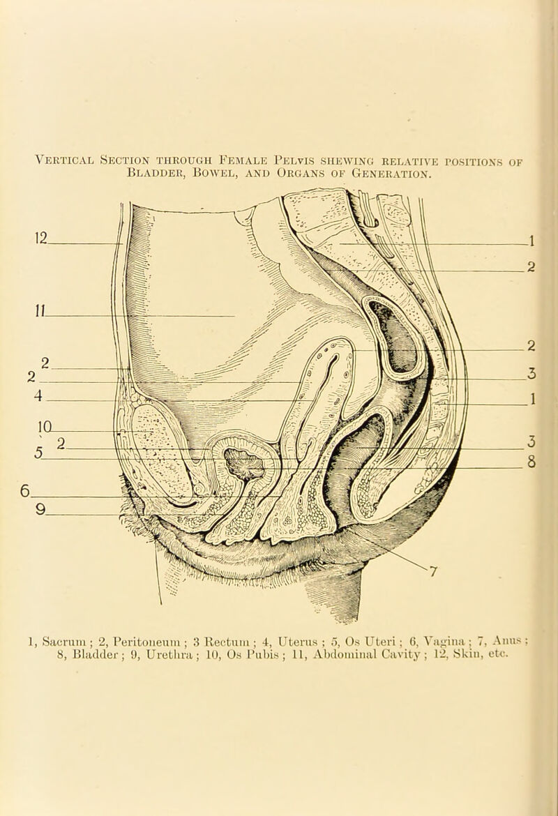 Vertical Section through Female Pelvis shewing relative positions of Bladder, Bowel, and Organs of Generation. 1, Sacrum ; 2, Peritoneum ; 3 Rectum; 4, Uterus ; 5, Os Uteri; 6, Vagina ; 7, Anus :