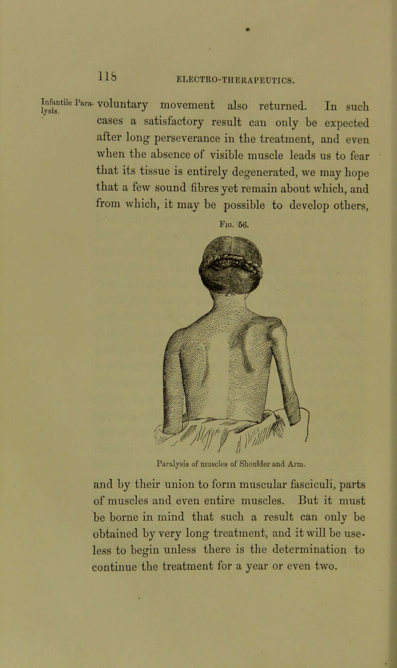 inMe p^. voluntRiy movement also returned. In such cases a satisfactory result can only be expected after long perseverance in the treatment, and even when the absence of visible muscle leads us to fear that its tissue is entirely degenerated, we may hope that a few sound fibres yet remain about which, and from which, it may be possible to develop others, Fig. 56. Paralysis of muscles of Shoulder and Arm. and by their union to form muscular fasciculi, parts of muscles and even entire muscles. But it must be borne in mind that such a result can only be obtained by very long treatment, and it will be use- less to begin unless there is the determination to continue the treatment for a year or even two.