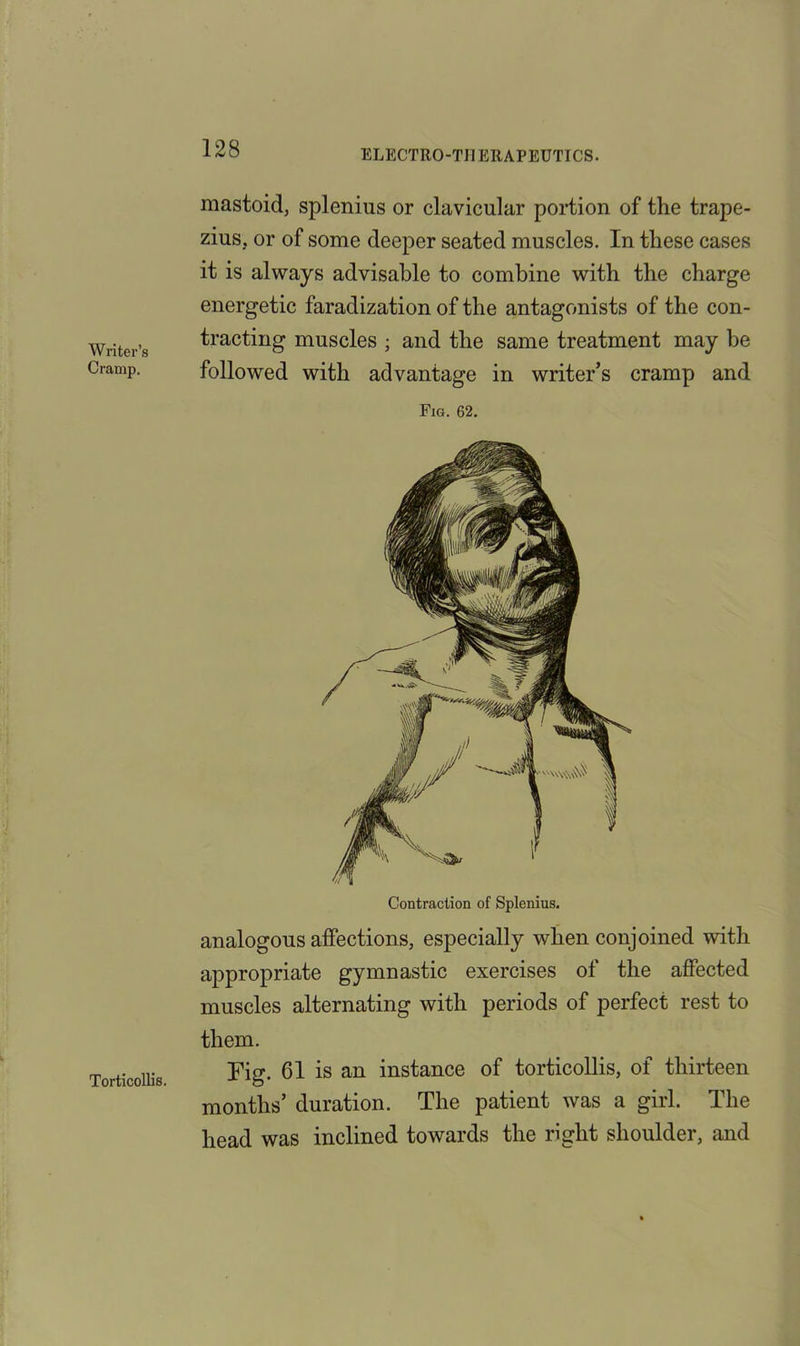 ELECTROTHERAPEUTICS. Writer’s Cramp. Torticollis. mastoid, splenius or clavicular portion of the trape- zius, or of some deeper seated muscles. In these cases it is always advisable to combine with the charge energetic faradization of the antagonists of the con- tracting muscles ; and the same treatment may be followed with advantage in writer’s cramp and Fig. 62. Contraction of Splenius. analogous affections, especially when conjoined with appropriate gymnastic exercises of the affected muscles alternating with periods of perfect rest to them. Tig. 61 is an instance of torticollis, of thirteen months’ duration. The patient was a girl. The head was inclined towards the right shoulder, and