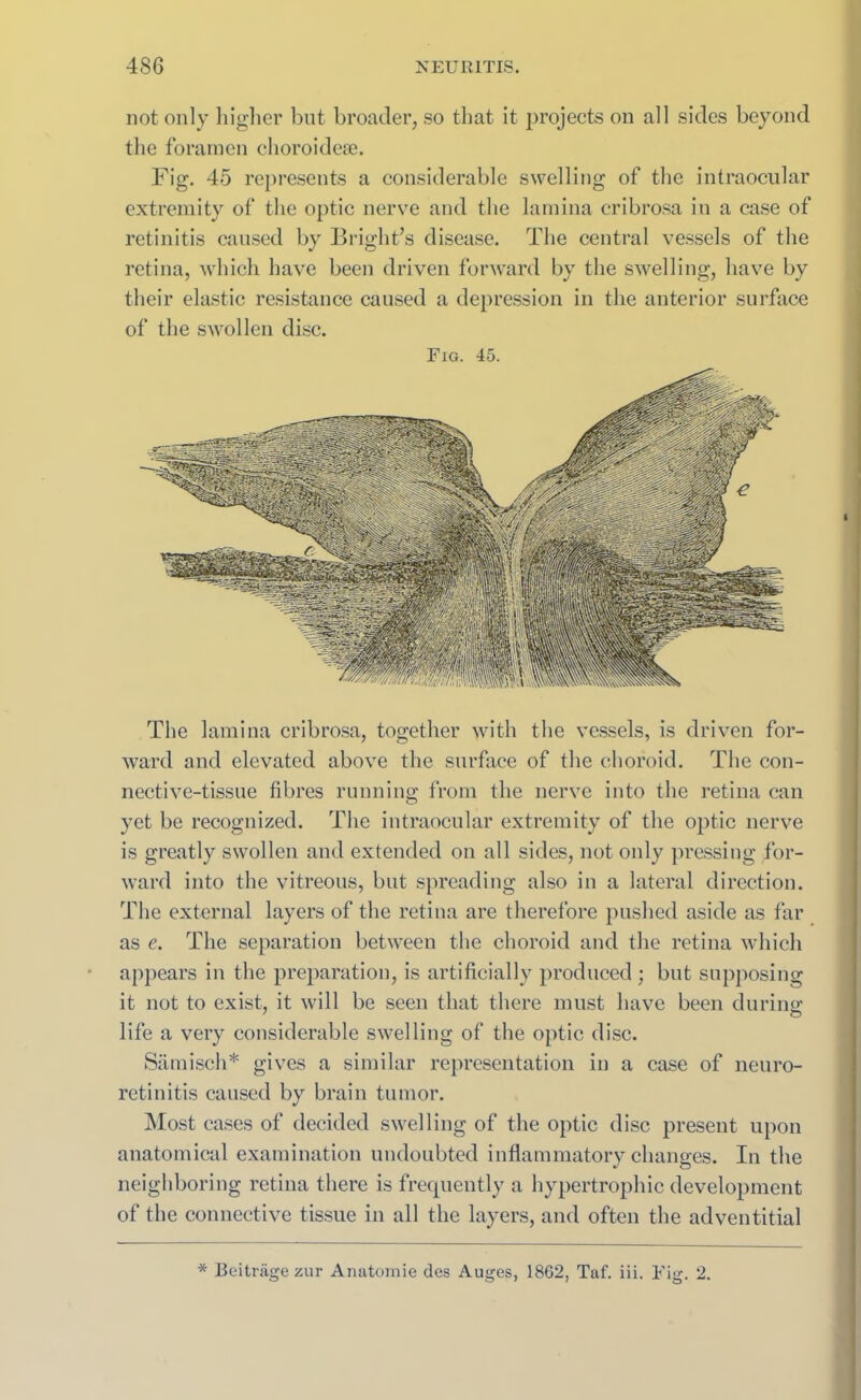 not only higher but broader, so that it projects on all sides beyond the foramen choroidese. Fig. 45 represents a considerable swelling of the intraocular extremity of the optic nerve and the lamina cribrosa in a case of retinitis caused by Bright’s disease. The central vessels of the retina, which have been driven forward by the swelling, have by their elastic resistance caused a depression in the anterior surface of the swollen disc. Fig. 45. The lamina cribrosa, together with the vessels, is driven for- ward and elevated above the surface of the choroid. The con- nective-tissue fibres running from the nerve into the retina can yet be recognized. The intraocular extremity of the optic nerve is greatly swollen and extended on all sides, not only pressing for- ward into the vitreous, but spreading also in a lateral direction. The external layers of the retina are therefore pushed aside as far as e. The separation between the choroid and the retina which appears in the preparation, is artificially produced ; but supposing it not to exist, it will be seen that there must have been during 7 o life a very considerable swelling of the optic disc. Samisch* gives a similar representation in a case of neuro- retinitis caused by brain tumor. Most cases of decided swelling of the optic disc present upon anatomical examination undoubted inflammatory changes. In the neighboring retina there is frequently a hypertrophic development of the connective tissue in all the layers, and often the adventitial * Beitrage zur Anatomie des Auges, 1862, Taf. iii. Fig. 2.