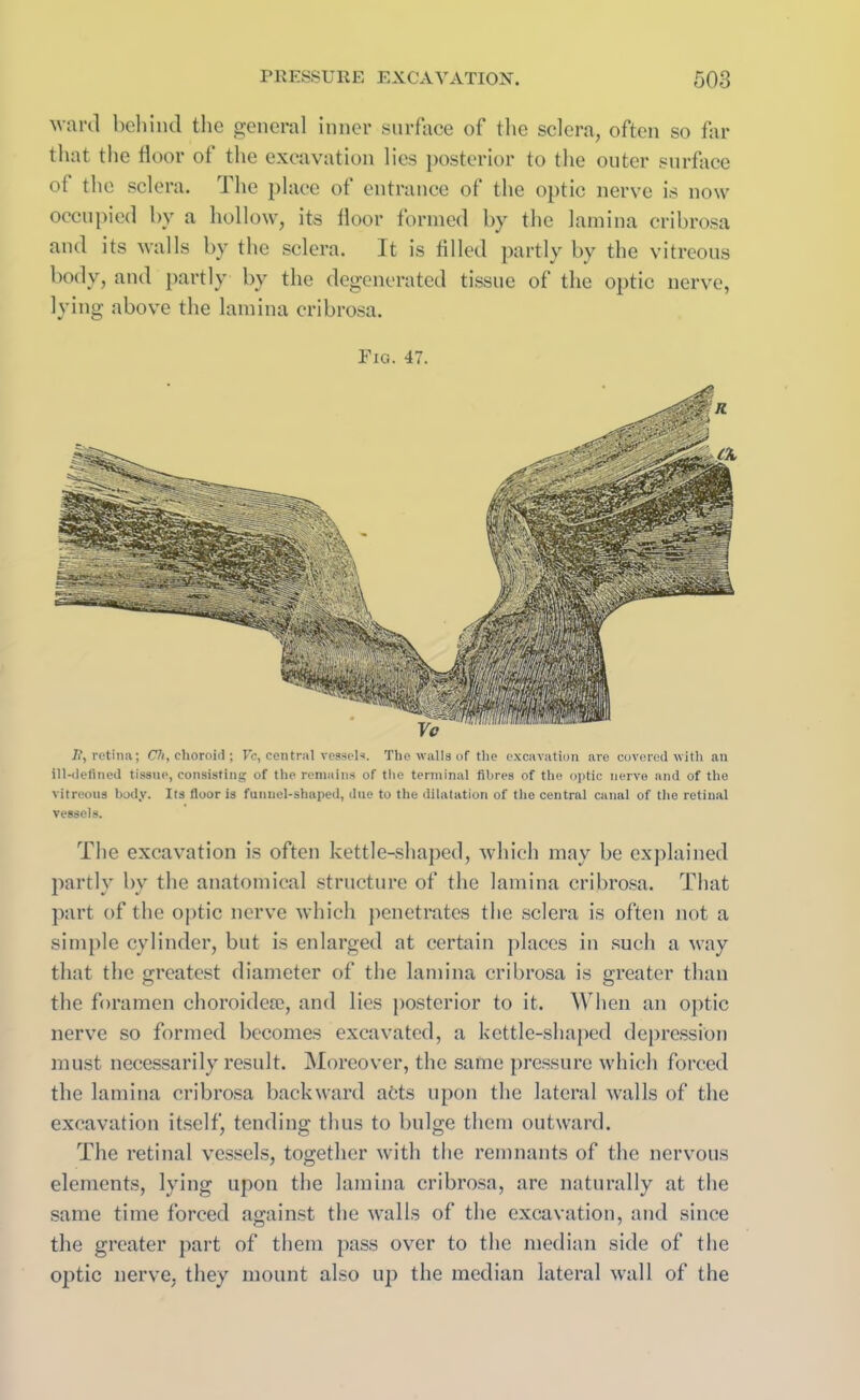 ward behind the general inner surface of the sclera, often so far that the floor of the excavation lies posterior to the outer surface ol the sclera. The place of entrance of the optic nerve is now occupied by a hollow, its floor formed by the lamina cribrosa and its walls by the sclera. It is filled partly by the vitreous body, and partly by the degenerated tissue of the optic nerve, lying above the lamina cribrosa. Fig. 47. I?, retina; Ch, choroid; Vc, central vessels. The walls of the excavation are covered with an ill-defined tissue, consisting of the remains of the terminal fibres of the optic nerve and of the vitreous body. Its floor is funnel-shaped, due to the dilatation of the central canal of the retinal vessels. The excavation is often kettle-shaped, which may be explained partly by the anatomical structure of the lamina cribrosa. That part of the optic nerve which penetrates the sclera is often not a simple cylinder, but is enlarged at certain places in such a way that the greatest diameter of the lamina cribrosa is greater than the foramen choroidere, and lies posterior to it. When an optic nerve so formed becomes excavated, a kettle-shaped depression must necessarily result. Moreover, the same pressure which forced the lamina cribrosa backward acts upon the lateral walls of the excavation itself, tending thus to bulge them outward. The retinal vessels, together with the remnants of the nervous elements, lying upon the lamina cribrosa, are naturally at the same time forced against the walls of the excavation, and since the greater part of them pass over to the median side of the optic nerve, they mount also up the median lateral wall of the