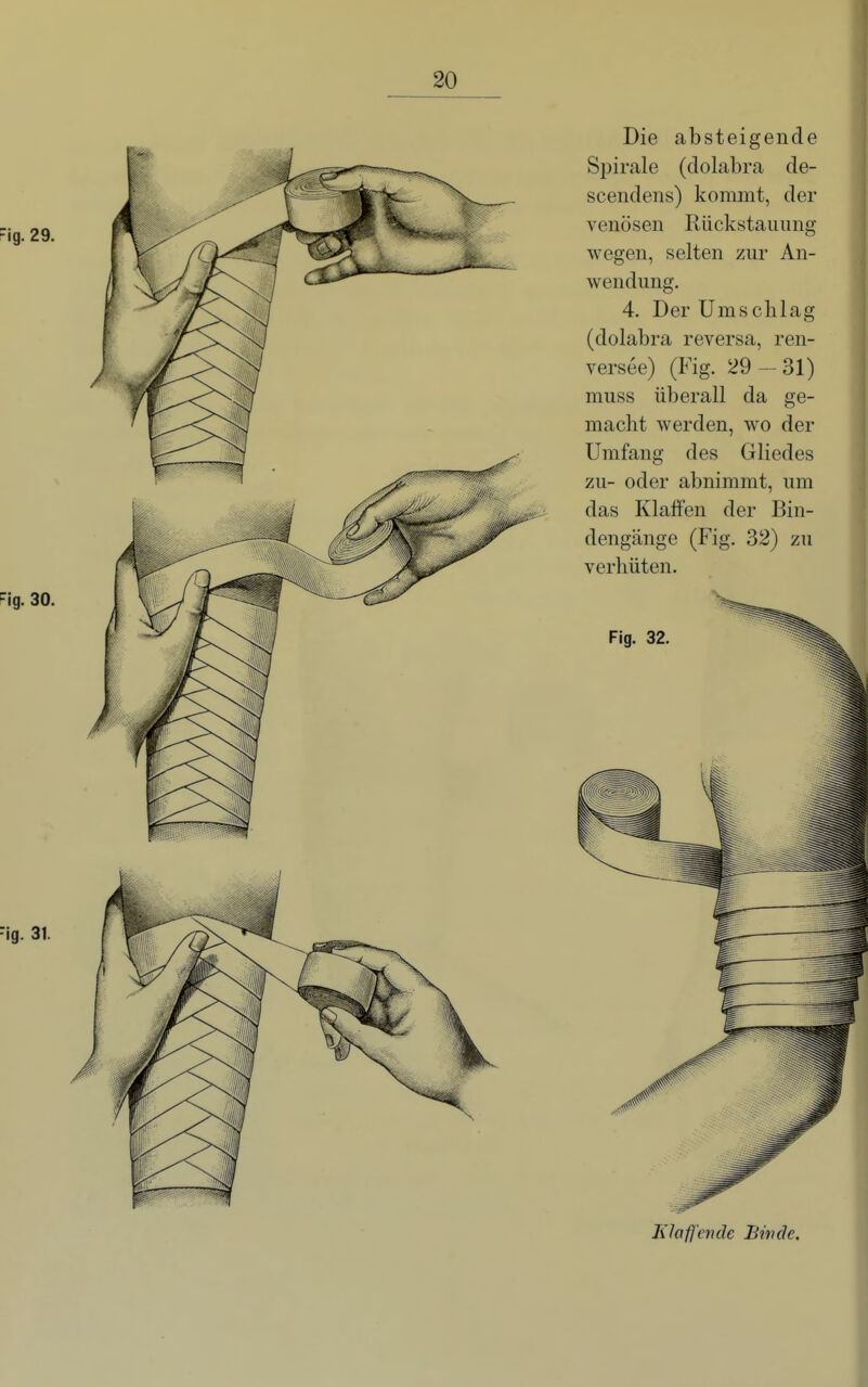 Die absteigende Spirale (dolabra de- scendens) kommt, der venösen Rückstauung wegen, selten zur An- wendung. 4. Der Umschlag (dolabra reversa, ren- versee) (Fig. 29 -31) muss überall da ge- macht werden, wo der Umfang des Gliedes zu- oder abnimmt, um das Klaffen der Bin- dengänge (Fig. 32) zu verhüten. Ehfj'ende Bin de.