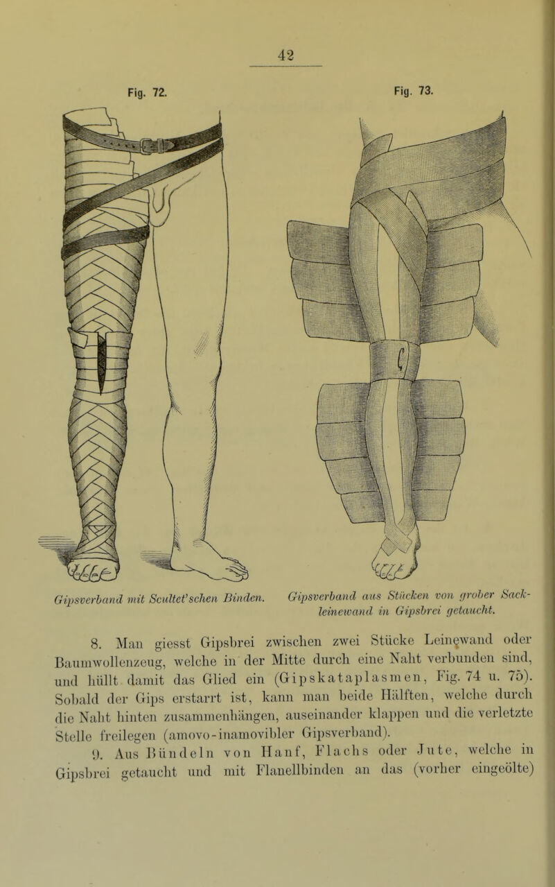 Fig. 72. Fig. 73. Gipsverband mit Scultet'sehen Binden. Gipsverhand aus Stücken von fjroher SacJc- leinewand in Gipsbrei getaucht. 8. Man giesst Gipsbrei zwischen zwei Stücke Leinewand oder Baiimwollenzeiig, welche in der Mitte durch eine Naht verbunden shid, und hüllt damit das Glied ein (Gipskataplasmen, Fig. 74 u. 75). Sobald der Gips erstarrt ist, kann man beide Hälften, welche durch die Naht hinten zusammenhängen, auseinander klappen und die verletzte Stelle freilegen (amovo-inamoviblcr Gipsverband). 9. Aus Bündeln von Hanf, Flachs oder Jute, welche in Gipsbrei getaucht und mit Flanellbinden an das (vorher eingeölte)