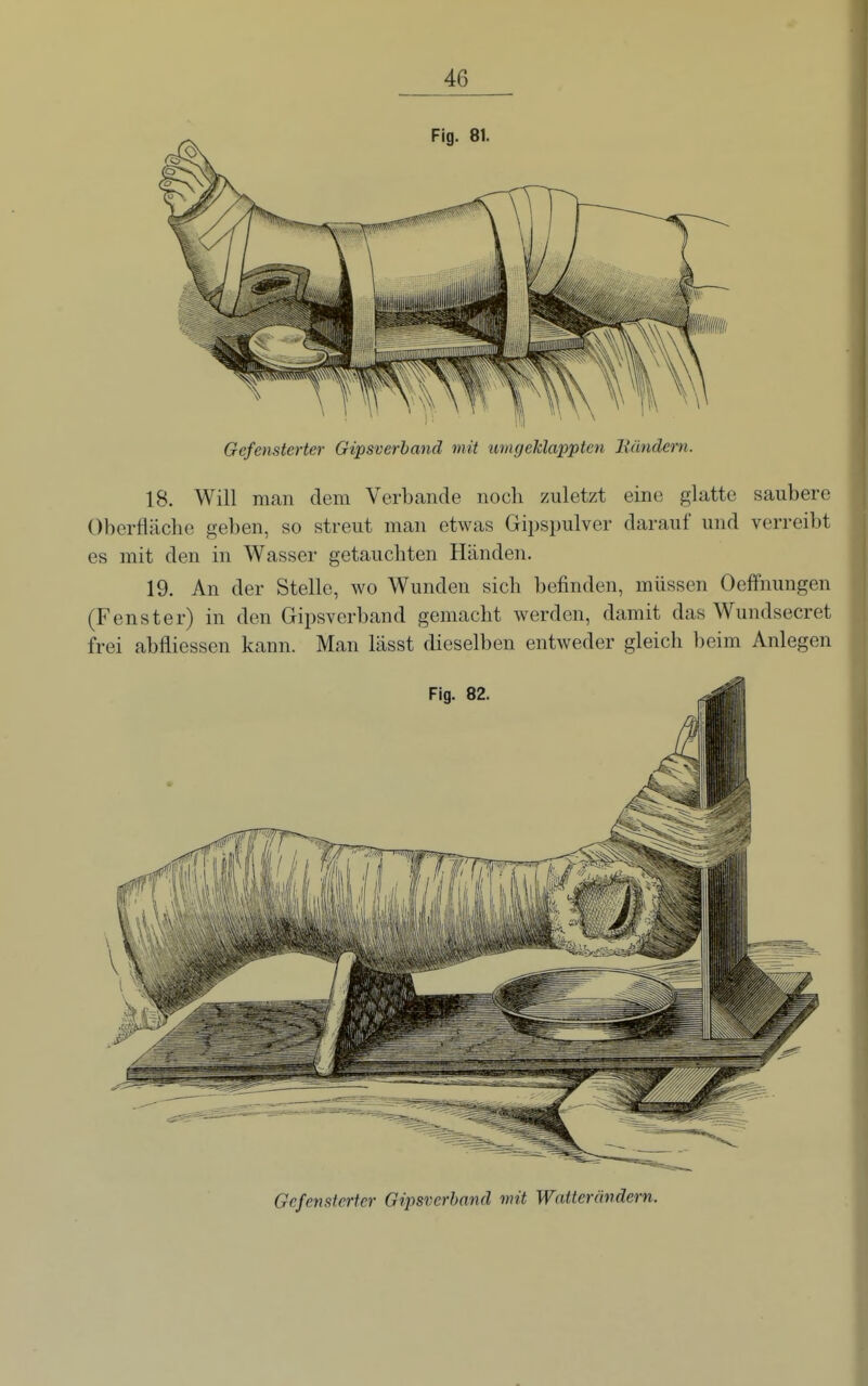 Gefensterter Gipsverhand mit umgeMapptcn Bändern. 18. Will man dem Verbände noch zuletzt eine glatte saubere Oberfläche geben, so streut man etwas Gipspulver darauf und verreibt es mit den in Wasser getauchten Händen. 19. An der Stelle, avo Wunden sich befinden, müssen Oelfnungen (Fenster) in den Gipsverband gemacht werden, damit das Wundsecret frei abfliessen kann. Man lässt dieselben entweder gleich beim Anlegen Gefensterter Gipsverhand mit Watterändern.
