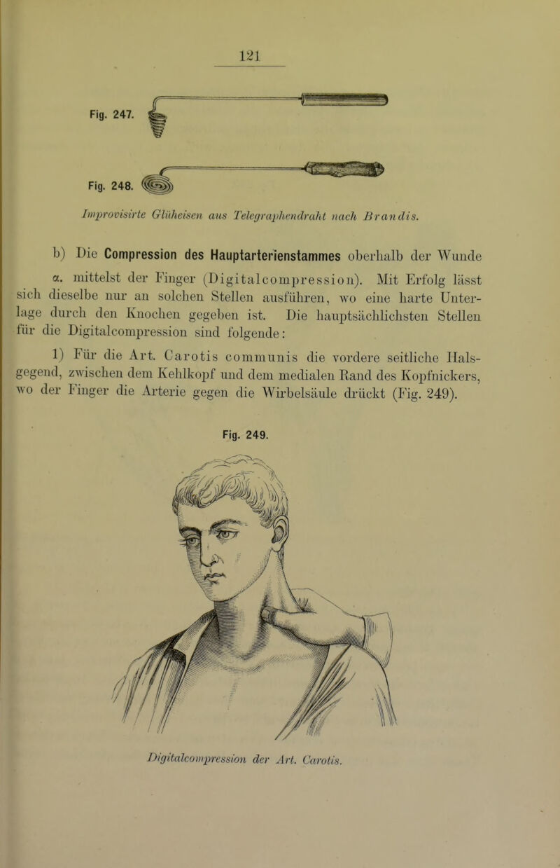 Fig. 247. Fig. 248. Improvisirte GUiheisen aus Telegraphendraht nach Brandis. b) Die Compression des Hauptarterienstammes oberhalb der Wunde a. mittelst der Finger (Digitalcompression). Mit Erfolg lässt sich dieselbe nur an solchen Stellen ausführen, wo eine harte Unter- lage durch den Knochen gegeben ist. Die hauptsächlichsten Stellen für die Digitalcompression sind folgende: 1) Für die Art. Carotis communis die vordere seitliche Hals- gegend, zwischen dem Kehlkopf und dem medialen Eand des Kopfnickers, wo der Finger die Arterie gegen die Wirbelsäule drückt (Fig. 249). Fig. 249. Digitalcompression der Art. Carotis.