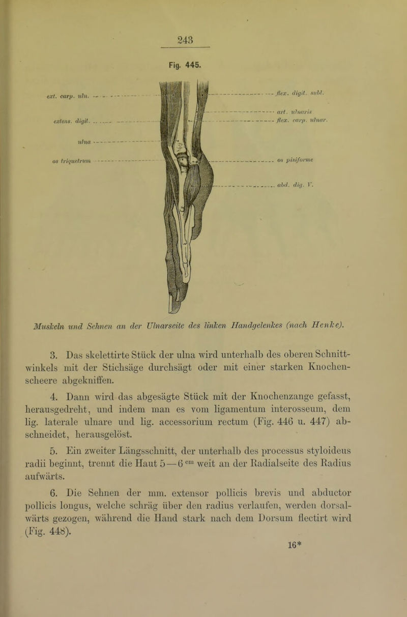 Fig. 445. ext. carp. uhi. ■- - exlens. diyil. .. .. nhta OS trique.trum Muskeln und Sehnen an der Ulnar seile des Unken Handgelenkes (nach Henke). 3. Das skelettirte Stück der ulna wird unterhalb des oberen Schnitt- winkels mit der Stichsäge durchsägt oder mit einer starken Knochen- scheere abgekniifen. 4. Dann wird das abgesägte Stück mit der Knochenzange gefasst, herausgedreht, und indem man es vom liganientum interosseum, dem lig. laterale ulnare und lig. accessorium rectum (Fig. 44G u. 447) ab- schneidet, herausgelöst. 5. Ein zweiter Längsschnitt, der unterhalb des processus styloideus radii beginnt, trennt die Haut 5 — 6 weit an der Radialseite des Radius aufwärts. 6. Die Sehnen der mm. extensor pollicis brevis und abductor poUicis longus, welche schräg über den radius verlaufen, werden dorsal- wärts gezogen, während die Hand stark nach dem Dorsum flectirt wird (Fig. 44b). 16*