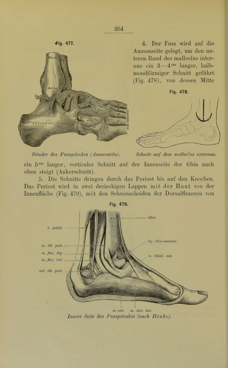 ^ig. 477. 4. Der Puss wird auf die Aussenseite gelegt, um den un- teren Rand des malleolus inter- nus ein 3 — 4™ langer, halb- mondförmiger Schnitt geführt (Fig. 478), von dessen Mitte Fig. 478. Bänder des FussgelenJces (Aussenseite). Schnitt auf dem malleolus externus. ein b'^^ langer, verticaler Schnitt auf der Innenseite der tibia nach oben steigt (Ankerschnitt). 5. Die Schnitte dringen durch das Periost bis auf den Knochen. Das Periost wird in zwei dreieckigen Lappen mit der Haut von der Innenfläche (Fig. 479), mit den Sehnenscheiden der Dorsalflexoren von Fig. 479. t. Achill. m. Hb. post. m. ßex. dig. m. ßcx. hal. art. (ib. posl. Hg. tibio-navicul. OS nav. m. abd. hal. Innere Seite des FussgelenJces (nach Henhc).
