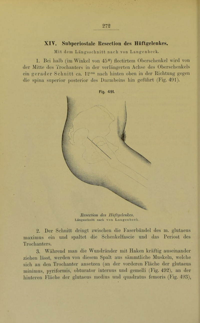 XIV. Siibperiostale Resectioii des Hüftgelenkes. Mit dem Längsschnitt nach von Langenbeck, 1. Bei halb (im Winkel von 45flectirtem Oberschenkel wird von der Mitte des Trochanters in der verlängerten Achse des Oberschenkels ein gerader Schnitt ca. l^«' nach hinten oben in der Richtung gegen die Spina snperior posterior des Darmbeins hin geführt (Fig. 491). Fig. 491. BesecHon des HüftgelcnJces. Tjängsschiiitt nach von Langenbeck. 2. Der Schnitt dringt zwischen die Faserbündel des m. glutaeus maximus ein und spaltet die Schenkelfascie und das Periost des Trochanters. 3. Während man die Wundränder mit Haken kräftig auseinander ziehen lässt, werden von diesem Spalt aus sämmtliche Muskeln, welche sich an den Trochanter ansetzen (an der vorderen Fläche der glutaeus minimus, pyriformis, obturator internus und gemelli (Fig. 492), an der hinteren Fläche der glutaeus medius und quadratus femoris (Fig. 493),