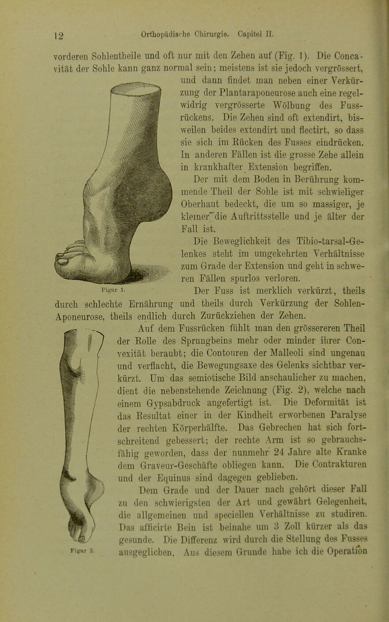 Figur 1. vorderen Sohlentheile und oft nur mit den Zehen auf (Fig. 1). Die Conca- vität der Sohle kann ganz normal sein; meistens ist sie jedoch vergrössert, und dann findet man neben einer Verkür- zung der Plantaraponeurose auch eine regel- widrig vergrösserte Wölbung des Fuss- rückens. Die Zehen sind oft extendirt, bis- weilen beides extendirt und flectirt, so dass sie sich im Kücken des Fusses eindrücken. In anderen Fällen ist die grosse Zehe allein in krankhafter Extension begriffen. Der mit dem Boden in Berührung kom- mende Theil der Sohle ist mit schwieliger Oberhaut bedeckt, die um so massiger, je kleiner~die Auftrittsstelle und je älter der Fall ist. Die Beweglichkeit des Tibio-tarsal-Ge- lenkes steht im umgekehrten Verhältnisse zum Grade der Extension und geht in schwe- ren Fällen spurlos verloren. Der Fuss ist merklich verkürzt, theils durch schlechte Ernährung und theils durch Verkürzung der Sohlen- Aponeurose, theils endlich durch Zurückziehen der Zehen. Auf dem Fussrücken fühlt man den grössereren Theil der Rolle des Sprungbeins mehr oder minder ihrer Con- vexität beraubt; die Contouren der Malleoli sind ungenau und verflacht, die Bewegungsaxe des Gelenks sichtbar ver- kürzt. Um das semiotische Bild anschaulicher zu machen, dient die nebenstehende Zeichnung (Fig. 2), welche nach einem Gypsabdruck angefertigt ist. Die Deformität ist das Resultat einer in der Kindheit erworbenen Paralyse der rechten Körperhälfte. Das Gebrechen hat sich fort- schreitend gebessert; der rechte Arm ist so gebrauchs- fähig geworden, dass der nunmehr 24 Jahre alte Kranke dem Graveur-Geschäfte obliegen kann. Die Contrakturen und der Equinus sind dagegen geblieben. Dem Grade und der Dauer nach gehört dieser Fall zu den schwierigsten der Art und gewährt Gelegenheit, die allgemeinen und speciellen Verhältnisse zu studiren. Das afficirte Bein ist beinahe um 3 Zoll kürzer als das gesunde. Die Differenz wird durch die Stellung des Fusses Figur 2. ausgeglichen. Aus diesem Grunde habe ich die Operation