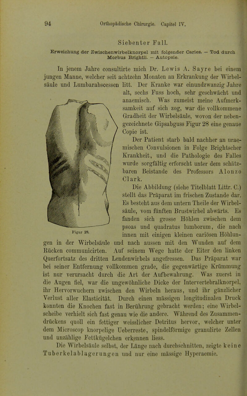 Siebenter Fall. Erweichung der Zwischenwirbelknorpel mit folgender Caries. — Tod durch Morbus Brightii. — Autopsie. In jenem Jahre consultirte mich Dr. Lewis A. Sayre bei einem jungen Manne, welcher seit achtzehn Monaten an Erkrankung der Wirbel- säule und Lumbarabscessen litt. Der Kranke war einundzwanzig Jahre alt, sechs Fuss hoch, sehr geschwächt und anaemisch. Was zumeist meine Aufmerk- samkeit auf sich zog, war die vollkommene Gradheit der Wirbelsäule, wovon der neben- gezeichnete Gipsabguss Figur 28 eine genaue Copie ist. Der Patient starb bald nachher an urae- mischen Convulsionen in Folge Brightscher Krankheit, und die Pathologie des Falles wurde sorgfältig erforscht unter dem schätz- baren Beistände des Professors Alonzo Clark. Die Abbildung (siehe Titelblatt Littr. C.) stellt das Präparat im frischen Zustande dar. Es besteht aus dem untern Theile der Wirbel- säule, vom fünften Brustwirbel abwärts. Es fanden sich grosse Höhlen zwischen dem psoas und quadratus lumborum, die nach innen mit einigen kleinen cariösen Höhlun- gen in der Wirbelsäule und nach aussen mit den Wunden auf dem Rücken communicirten. Auf seinem Wege hatte der Eiter den linken Querfortsatz des dritten Lendenwirbels angefressen. Das Präparat war bei seiner Entfernung vollkommen grade, die gegenwärtige Krümmung ist nur verursacht durch die Art der Aufbewahrung. Was zuerst in die Augen fiel, war die ungewöhnliche Dicke der Intervertebralknorpel, ihr Hervorwuchern zwischen den Wirbeln heraus, und ihr gänzlicher Verlust aller Elasticität. Durch einen mässigeu longitudinalen Druck konnten die Knochen fast in Berührung gebracht werden; eine Wirbel- scheibe verhielt sich fast genau wie die andere. Während des Zusammen- drückens quoll ein fettiger weisslicher Detritus hervor, welcher unter dem Microscop knorpelige Ueberreste, spindelförmige granulirte Zellen und unzählige Fettkügelchen erkennen Hess. Die Wirbelsäule selbst, der Länge nach durchschnitten, zeigte keine Tuberkelablagerungen und nur eine massige Hyperaemie.