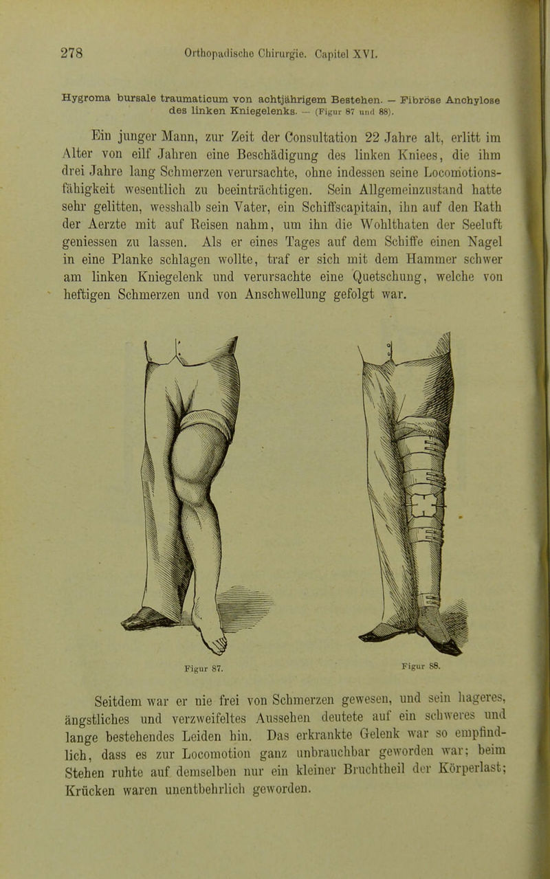 Hygroma bursale traumaticum von achtjährigem Bestehen. — Fibröse Anchylose des linken Kniegelenks. — (Figur 87 und 88). Ein junger Mann, zur Zeit der Consultation 22 Jahre alt, erlitt im Alter von eilf Jahren eine Beschädigung des linken Kniees, die ihm drei Jahre lang Schmerzen verursachte, ohne indessen seine Locomotions- fähigkeit wesentlich zu beeinträchtigen. Sein Allgemeinzustand hatte sehr gelitten, wesshalb sein Vater, ein Schiffscapitain, ihn auf den Rath der Aerzte mit auf Reisen nahm, um ihn die Wohlthaten der Seeluft geniessen zu lassen. Als er eines Tages auf dem Schiffe einen Nagel in eine Planke schlagen wollte, traf er sich mit dem Hammer schwer am linken Kniegelenk und verursachte eine Quetschung, welche von heftigen Schmerzen und von Anschwellung gefolgt war. Figur 87. Fi8ur sß- Seitdem war er nie frei von Schmerzen gewesen, und sein hageres, ängstliches und verzweifeltes Aussehen deutete auf ein schweres und lange bestehendes Leiden hin. Das erkrankte Gelenk war so empfind- lich, dass es zur Locomotion ganz unbrauchbar geworden war; beim Stehen ruhte auf demselben nur ein kleiner Bruchtheil der Körperlast; Krücken waren unentbehrlich geworden.