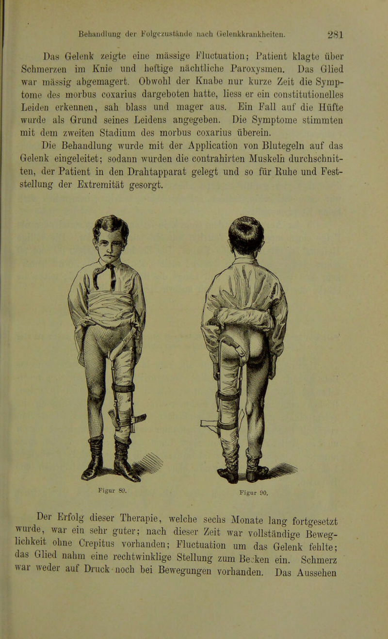 Das Gelenk zeigte eiue massige Fluctuation; Patient klagte über Schmerzen im Knie und heftige nächtliche Paroxysmen. Das Glied war massig abgemagert. Obwohl der Knabe nur kurze Zeit die Symp- tome des morbus coxarius dargeboten hatte, liess er ein constitutionelles Leiden erkennen, sah blass und mager aus. Ein Fall auf die Hüfte wurde als Grund seines Leidens angegeben. Die Symptome stimmten mit dem zweiten Stadium des morbus coxarius überein. Die Behandlung wurde mit der Application von Blutegeln auf das Gelenk eingeleitet; sodann wurden die contrahirten Muskeln durchschnit- ten, der Patient in den Drahtapparat gelegt und so für Ruhe und Fest- stellung der Extremität gesorgt. Figur 89. Figur 90. Der Erfolg dieser Therapie, welche sechs Monate lang fortgesetzt wurde, war ein sehr guter; nach dieser Zeit war vollständige Beweg- lichkeit ohne Crepitus vorhanden; Fluctuation um das Gelenk fehlte; das Glied nahm eine rechtwinklige Stellung zum Becken ein. Schmerz war weder auf Druck noch bei Bewegungen vorhanden. Das Aussehen