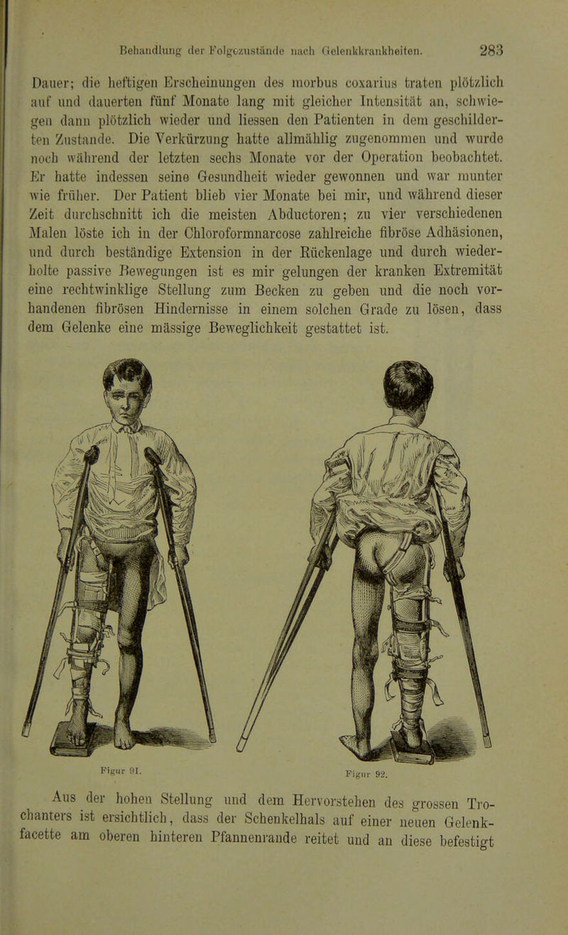 Dauer; die heftigen Erscheinungen des morbus coxarius traten plötzlich auf und dauerten fünf Monate lang mit gleicher Intensität an, schwie- gen dann plötzlich wieder und Hessen den Patienten in dem geschilder- ten Zustande. Die Verkürzung hatte allmählig zugenommen und wurde noch während der letzten sechs Monate vor der Operation beobachtet. Er hatte indessen seine Gesundheit wieder gewonnen und war munter ■wie früher. Der Patient blieb vier Monate bei mir, und während dieser Zeit durchschnitt ich die meisten Abductoren; zu vier verschiedenen Malen löste ich in der Chloroformnarcose zahlreiche fibröse Adhäsionen, und durch beständige Extension in der Rückenlage und durch wieder- holte passive Bewegungen ist es mir gelungen der kranken Extremität eine rechtwinklige Stellung zum Becken zu geben und die noch vor- handenen fibrösen Hindernisse in einem solchen Grade zu lösen, dass dem Gelenke eine mässige Beweglichkeit gestattet ist. Figur 91. Pignr 92< Aus der hohen Stellung und dem Hervorstehen des grossen Tro- chanters ist ersichtlich, dass der Schenkelhals auf einer neuen Gelenk- facette am oberen hinteren Pfannenrande reitet und an diese befestigt