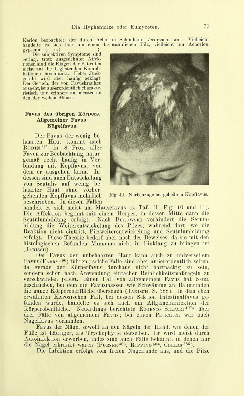 Kerion beobachtet, der durch Achorion Schönleiaü \'erursacht war. Vielleicht handelte es sich hier um einen favusähnlichen Pilz, vielleicht um Achorion gypseum (s. u.)- ! Die subjektiven Symptome sind gering, trotz ausgedehnter Affek- tionen sind die Klagen der Patienten meist auf die begleitenden Kompli- kationen beschränkt. Ueber Juck- gefiihl wird aber häufig geklagt. Der Geruch, der von Favuskranken ausgeht, ist außerordentlich charakte- ristisch und erinnert am meisten an den der weißen Mäuse. Favus des übrigen Körpers. Allgemeiner Favus. Nägelfavus. Der Favus der wenig be- haarten Haut kommt nach BoDiN 3 in 8 Proz. aller Faven zur Beobachtung, natur- gemäß recht häufig in Ver- bindung mit Kopffavus, von dem er ausgehen kann. In- dessen sind auch Entwickelung von Scutulis auf wenig be- haarter Haut ohne vorher- gehenden Kopffavus mehrfach Fig. 40. Narbenzüge bei geheiltem Kopffavus. beschrieben. In diesen Fällen handelt es sich meist um Mäusefavus (s. Taf. II, Fig. 10 und 11). Die Affektion beginnt mit einem Herpes, in dessen Mitte dann die Scutulumbildung erfolgt. Nach Bukowski verhindert die Serum- bildung die Weiterentwickelung des Pilzes, während dort, wo die Reaktion nicht eintritt, Pilzweiterentwickelung und Scutulumbildung erfolgt. Diese Theorie bedarf aber noch des Beweises, da sie mit den histologischen Befunden Mibellis nicht in Einklang zu bringen ist (J arisch). Der Favus der unbehaarten Haut kann auch zu universellem Favus (Fabry 390) führen; solche Fälle sind aber außerordentlich selten, da gerade der Körperfavus durchaus nicht hartnäckig zu sein, sondern schon nach Anwendung einfacher Eeinlichkeitsmaßregeln zu verschwinden pflegt. Einen Fall von allgemeinem Favus hat Nobl beschrieben, bei dem die Favusmassen wie Schwämme an Baumrinden die ganze Körperoberfläche überzogen (Jarisch, S. 588). In dem oben erwähnten KAPosischen Fall, bei dessen Sektion Intestinalfavus ge- funden wurde, handelte es sich auch um Allgemeininfektion der Körperoberfläche. Neuerdings berichtete Eugenio Silpari''^o'^^ä' über drei Fälle von allgemeinem Favus; bei einem Patienten war auch Nagelfavus vorhanden. Favus der Nägel sowohl an den Nägeln der Hand, wie denen der Füße ist häufiger, als Trychophytie derselben. Er wird meist durch Autoinfektion erworben, indes sind auch Fälle bekannt, in denen nur die Nägel erkrankt waren (Purser^^^^ Ripping*04^ Collas^^s), Die Infektion erfolgt vom freien Nagelrande aus, und die Pilze