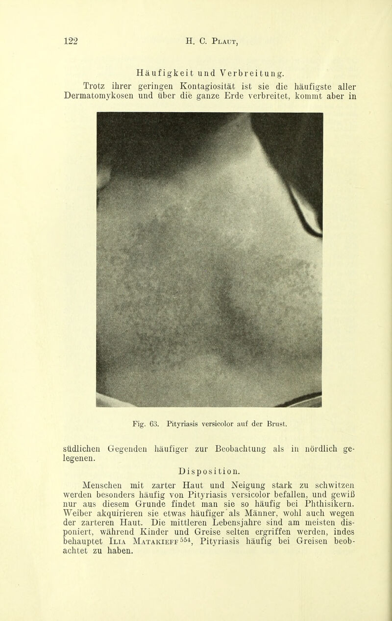 Häufigkeit und Verbreitung. Trotz ihrer geringen Kontagiosität ist sie die häufigste aller Dermatomykosen und über die ganze Erde verbreitet, kommt aber in Fig. 63. Pityriasis versicolor auf der Brust. südlichen Gegenden häufiger zur Beobachtung als in nördlich ge- legenen. Disposition. Menschen mit zarter Haut und Neigung stark zu schwitzen werden besonders häufig von Pityriasis versicolor befallen, und gewiß nur aus diesem Grunde findet man sie so häufig bei Plithisikern. Weiber akquirieren sie etwas häufiger als Männer, wohl auch wegen der zarteren Haut. Die mittleren Lebensjahre sind am meisten dis- poniert, während Kinder und Greise selten ergriffen werden, indeiS behauptet Ilia Matakieff s^^^, Pityriasis häufig bei Greisen beob- achtet zu haben.