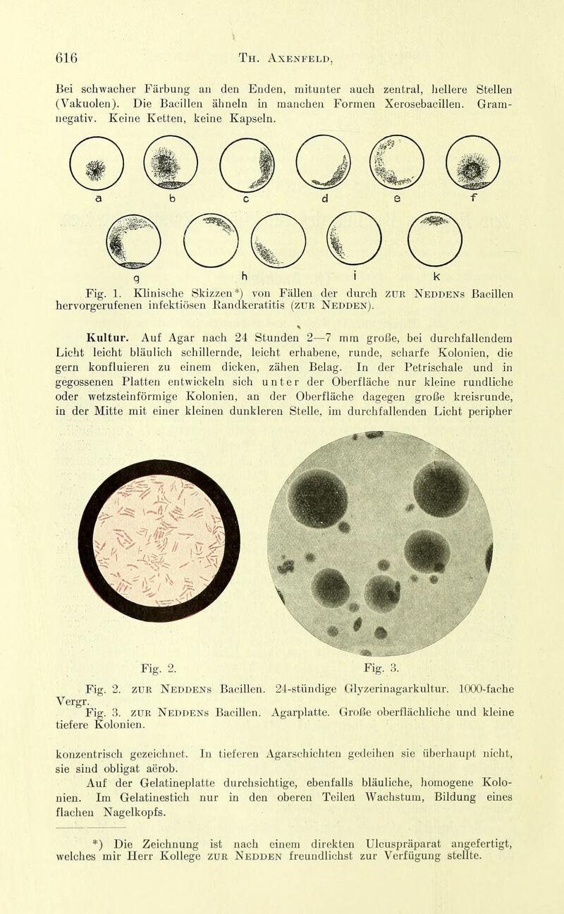 Bei schwacher Färbung an den Enden, mitunter auch zentral, hellere Stellen (Vakuolen). Die Bacillen ähneln in manchen Formen Xerosebacillen. Gram- negativ. Keine Ketten, keine Kapseln. g h i k Fig. 1. Klinische Skizzen*) von Fällen der durch zur Neddens Bacillen hervorgerufenen infektiösen Eandkeratitis (zur Nedden). Kultur. Auf Agar nach 24 Stunden 2—7 mm große, bei durchfallendem Licht leicht bläulich schillernde, leicht erhabene, runde, scharfe Kolonien, die gern konfluieren zu einem dicken, zähen Belag. In der Petrischale und in gegosseneu Platten entwickeln sich unter der Oberfläche nur kleine rundliche oder wetzsteinförmige Kolonien, an der Oberfläche dagegen große kreisrunde, in der Mitte mit einer kleineu dunkleren Stelle, im durchfallenden Licht peripher Fig. 2. Fig. 3. Fig. 2. ZUR Neddens Bacillen. 2J:-stündige Glyzerinagarkultur. 1000-fache Vergr. Fig. 3. ZUR Neddens Bacillen. Agarplatte. Große oberflächliche und kleine tiefere Kolonien. konzentrisch gezeichnet. In tieferen Agarschicht^ gedeihen sie überhaupt nicht, sie sind obligat aerob. Auf der Gelatineplatte durchsichtige, ebenfalls bläuliche, homogene Kolo- nien. Im Gelatinestich nur in den oberen Teileü Wachstum, Bildung eines flachen Nagelkopfs. *) Die Zeichnung ist nach einem direkten Ulcuspräparat angefertigt, welches mir Herr Kollege zur Nedden freundlichst zur Verfügung stellte.