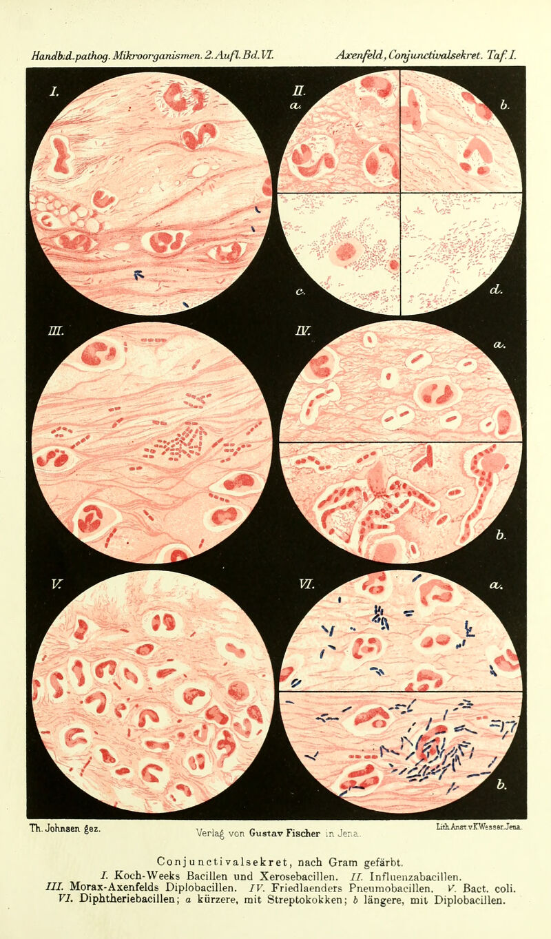 Handbid.pathog.Mikroorganismen.2.Auß.Bd.V[. Axenfeld,Conjunctivalsekret. Taf.I. Th JnKnaen äez n i . ^ , , Lith.Anstv.KWesser.Jea in.donnsen gez. Verlag von Gustav Fischer m Jena. Conjunctivalsekret, nach Gram gefärbt. /. Koch-Weeks Bacillen und Xerosebacillen. //. Infliienzabacillen. ///. Morax-Axenfelds Diplobacillen. IV. Friedlaenders Pneiimobacillen. V. ßact. coli. VI. Diphtheriebacillen; a kürzere, mit Streptokokken; b längere, nait Diplobacillen.