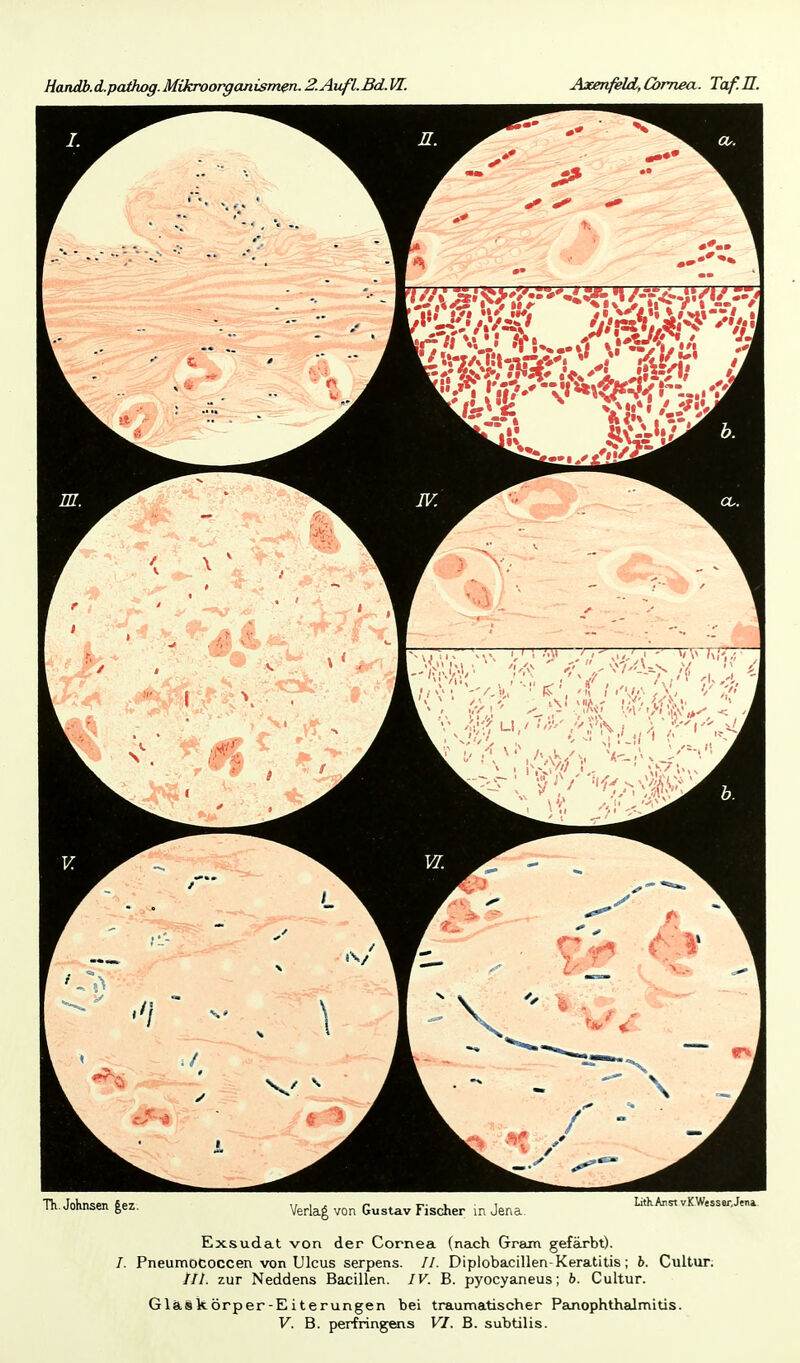 Handb.d.pathog.Mikroorganism^. Z.Aufl.Bd.W. Axenfelci, Cornea. Taf.U. Th. Johnsen |ez. Verlag von Gustav Fischer in Jena. LitKAnst vK Wesser.Jtna. Exsudat von der Cornea (nach Gram gefärbt). /. Pneumococcen von Ulcus serpens. //. Diplobacillen-Keratitis; h. Cultur. ///. zur Neddens Bacillen. IV. B. pyocyaneus; h. Cultur. Glaskörper-Eiterungen bei traumatischer Pajiophthaimitis.