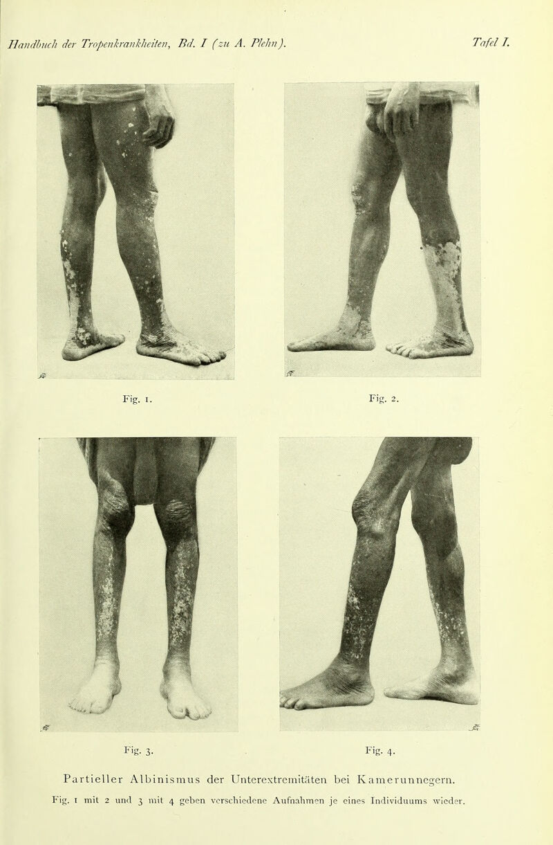 Fig. 3- Fig. 4. Partieller Albinismus der Unterextremitäten bei Kamerunnegern. Fig. T mit 2 und 3 mit 4 geben verschiedene Aufnahmen je eines Individuums wieder.