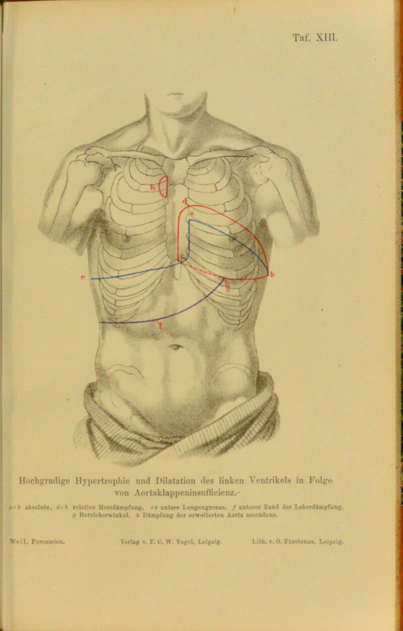 a Hochgradige Hypertrophie und Dilatation des linken Ventrikels in Folge von Aortaklappeninsuffieienz. «eb absolute, dcb relative Heradlmpfang. r« untere Lnngengrenze. / unterer Band der Loberdämpfung, g UerileborwinVeL A Dämpfung der erweiterten Aorta aacendens.