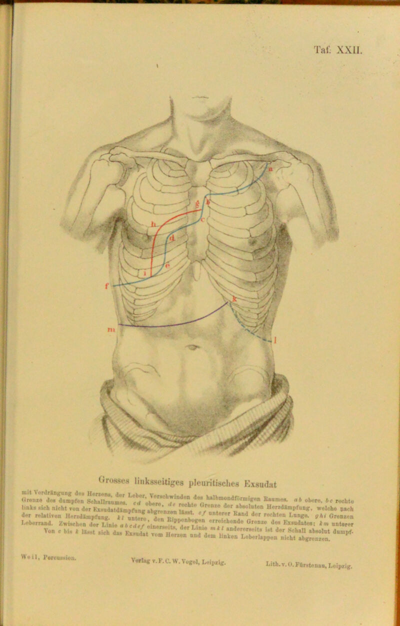 Tafi XXII. \ Grosses linksseitiges pleuritiscl.es Exsudat (in..,,« jJsaamp?^ SL’lräum^.*“■««■ «* oben, bc rechte Von . big * U,, .ich dag Ex,„d.t r,m Herten und ^ Weil, I’orcussiun.