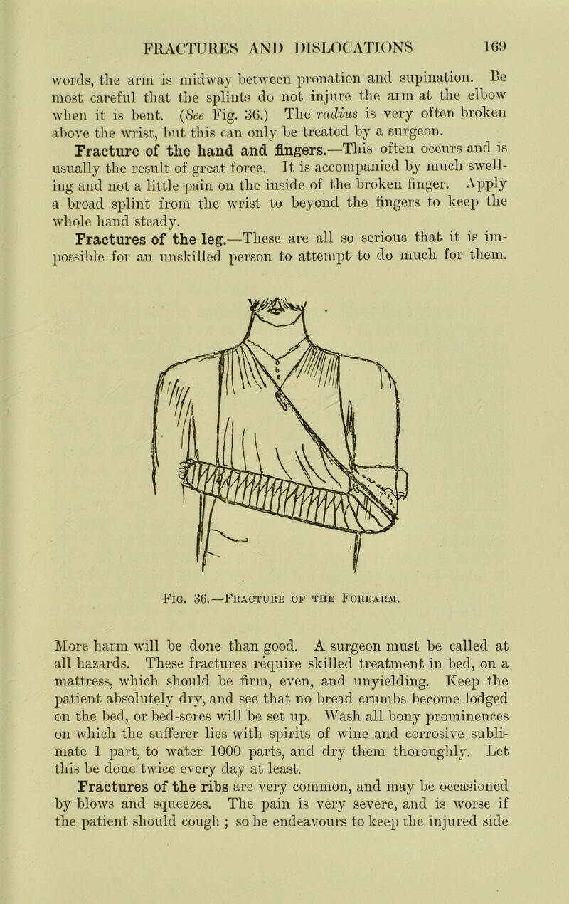 words, the arm is midway between pronation and supination. Re most careful that the splints do not injure the arm at the elbow when it is bent. (See Fig. 36.) The radius is very often broken above the wrist, but this can only be treated by a surgeon. Fracture of the hand and fingers.—This often occurs and is usually the result of great force. It is accompanied by much swell- ing and not a little pain on the inside of the broken finger. Apply a broad splint from the wrist to beyond the fingers to keep the whole hand steady. Fractures of the leg.—These are all so serious that it is im- possible for an unskilled person to attempt to do much for them. Fig. 36.—Fracture of the Forearm. More harm will be done than good. A surgeon must be called at all hazards. These fractures require skilled treatment in bed, on a mattress, which should be firm, even, and unyielding. Keep the patient absolutely dry, and see that no bread crumbs become lodged on the bed, or bed-sores will be set up. Wash all bony prominences on which the sufferer lies with spirits of wine and corrosive subli- mate 1 part, to water 1000 parts, and dry them thoroughly. Let this be done twice every day at least. Fractures of the ribs are very common, and may be occasioned by blows and squeezes. The pain is very severe, and is worse if the patient should cough ; so he endeavours to keep the injured side