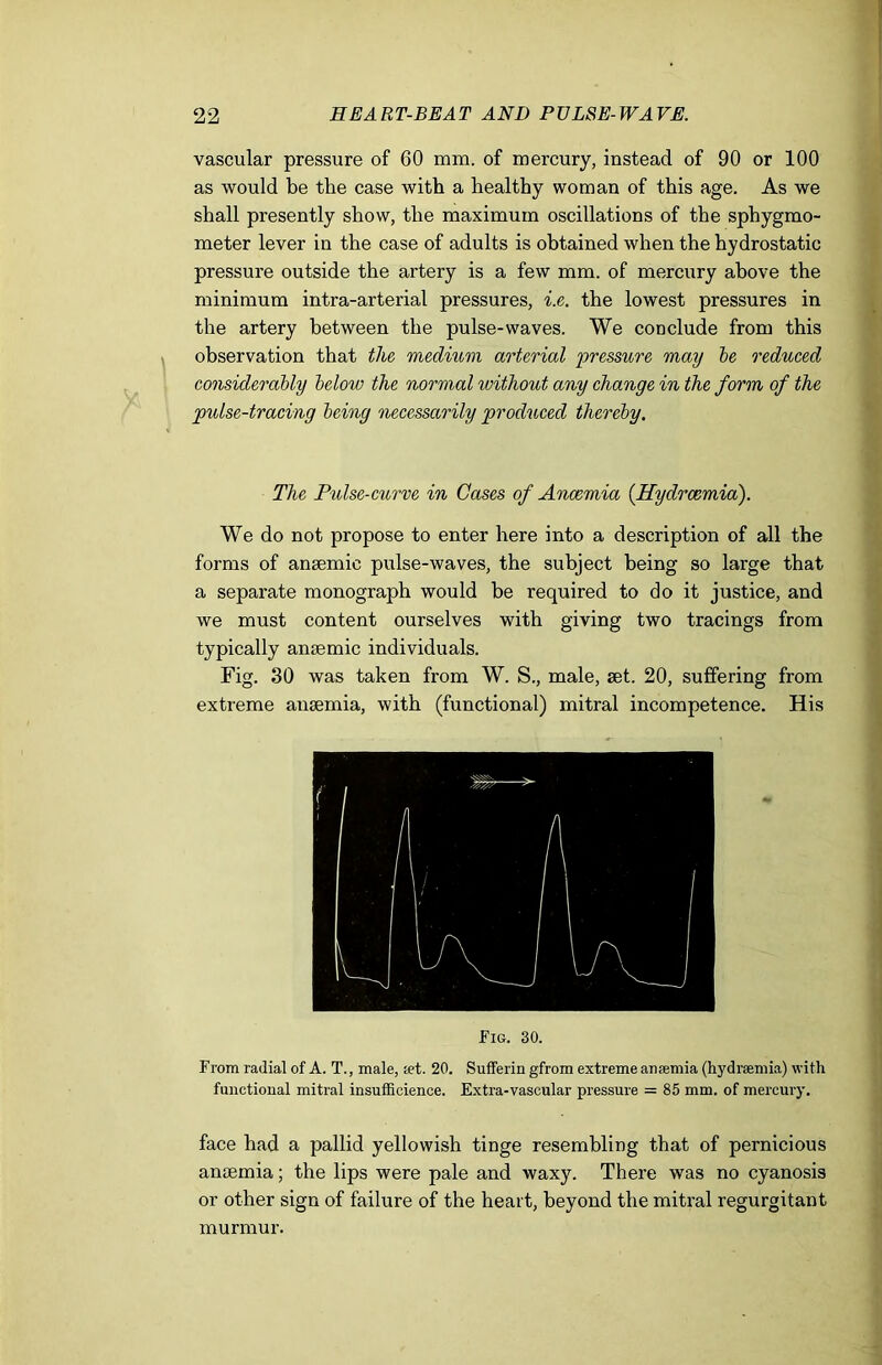 vascular pressure of 60 mm. of mercury, instead of 90 or 100 as would be the case with a healthy woman of this age. As we shall presently show, the maximum oscillations of the sphygmo- meter lever in the case of adults is obtained when the hydrostatic pressure outside the artery is a few mm. of mercury above the minimum intra-arterial pressures, i.e. the lowest pressures in the artery between tbe pulse-waves. We conclude from this observation that the medium arterial pressure may be reduced considerably below the normal without any change in the form of the pulse-tracing being necessarily produced thereby. The Pulse-curve in Gases of Anaemia (.Hydrcemia). We do not propose to enter here into a description of all the forms of anaemic pulse-waves, the subject being so large that a separate monograph would be required to do it justice, and we must content ourselves with giving two tracings from typically anaemic individuals. Fig. 30 was taken from W. S., male, aet. 20, suffering from extreme anaemia, with (functional) mitral incompetence. His Fig. 30. From radial of A. T., male, set. 20. Sufferin gfrom extreme ansemia (hydrsemia) with functional mitral insufficience. Extra-vascular pressure = 85 mm. of mercury. face had a pallid yellowish tinge resembling that of pernicious anaemia; the lips were pale and waxy. There was no cyanosis or other sign of failure of the heart, beyond the mitral regurgitant murmur.