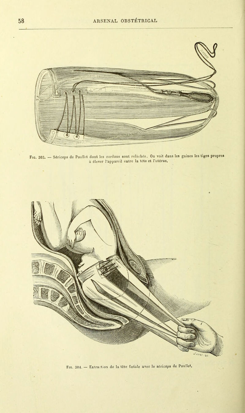 Fig. 304.— Extraction de la tête foetale avec le sériceps de Poullet.