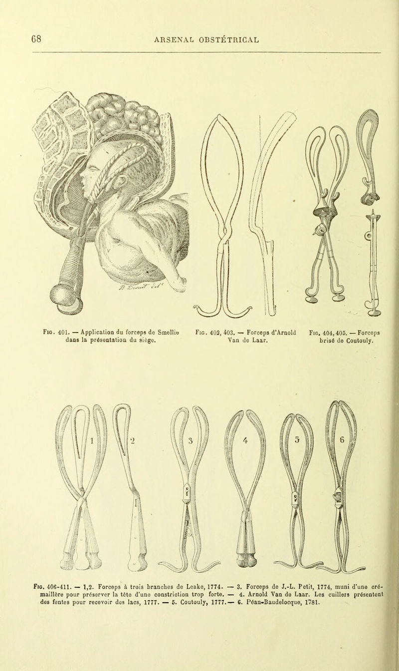 Fio. 401. — Application du forceps de Smellie dans la présentation du siège. Fio. 402, 403. — Forceps d’Arnold Van de Laar. Fig. 404,405. — Forceps brisé de Coutouly. Fio. 406-411. — 1,2. Forceps à trois branches de Leako, 1774. — 3. Forceps de J.-L. Petit, 1774, muni d’une cré- maillère pour préserver la tête d’une constriction trop forte. — 4. Arnold Van de Laar. Les cuillers présentent