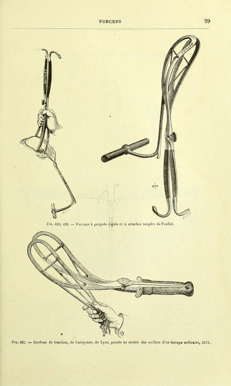 Fig. 630, 631.— Forceps à poignée rigide et à attaches souples de Poullet. Fig. 632 — Cordons de traction, de Laroycone, de Lyon, passés au centre des cuillers d’un forceps ordinaire, 1875.