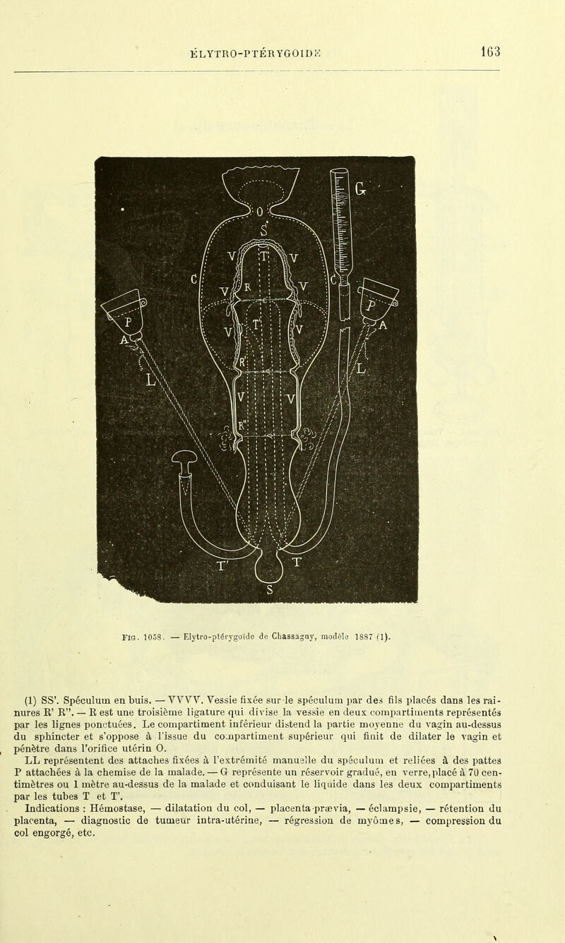 Fig. 1058. — F.lytro-ptérygoïde de Chassagny, modèle 1S87 (1). (1) SS’. Spéculum en buis. — WW. Vessie fixée sur le spéculum par des fils placés dans les rai- nures R’ R”. — R est une troisième ligature qui divise la vessie en deux compartiments représentés par les lignes ponctuées. Le compartiment inférieur distend la partie moyenne du vagin au-dessus du sphincter et s’oppose à l'issue du compartiment supérieur qui finit de dilater le vagin et pénètre dans l’orifice utérin O. LL représentent des attaches fixées à l’extrémité manuelle du spéculum et reliées à des pattes P attachées à la chemise de la malade. — G représente un réservoir gradué, en verre, placé à 7Ü cen- timètres ou 1 mètre au-dessus de la malade et conduisant le liquide dans les deux compartiments par les tubes T et T’. Indications : Hémostase, — dilatation du col, — placenta prævia, — éclampsie, — rétention du placenta, — diagnostic de tumeur intra-utérine, — régression de myômes, — compression du col engorgé, etc.