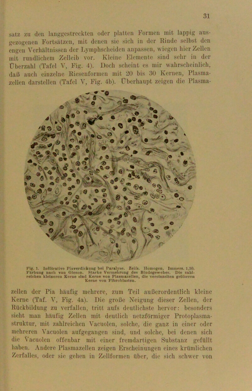 satz zu den langgestreckten Oder platten Formen mit lappig aus- gezogenen Fortsatzen, mit denen sic sich in der Rinde selbst den engen Verbal tnissen der Lymphscheiden anpassen, wiegen liier Zellen mit rundlichem Zelleib vor. Kleine Elemente sind sehr in der flberzahl (Tafel V, Fig. 4). Doch scheint es mir wahrscheinlich, daB auch einzelne Riesenformen mit 20 bis 30 Kcrnen, Plasma- zellen darstellen (Tafel V, Fig. 4b). Uberhaupt zeigen die Plasma- \\ &• m •T 3 * A \« 9.... ‘% v - Fig. 1. Infiltrative Piaverdickung bei Paralyse. Zeifs. Homogen. Iminers. 1,30. Fiirbuiig naeh van Oicson. Starke Vermehrung des Blndegew-ebes. Die zabl- reichen kleineren Kerne sind Kerne von Plasniazellen, die vereinzelten grofseren Kerne von Fibroblasten. zellen der Pia hiiufig mehrere, zum Teil auBerordentlich kleine Kerne (Taf. V, Fig. 4a). Die grofle Neigung dieser Zellen, der Rtickbildung zu verfallen, tritt aufs deutlichste hervor: besonders sielit man haufig Zellen mit deutlicli netzformiger Protoplasma- struktur, mit zahlreichen Vacuolen, solche, die ganz in einer oder mehreren Vacuolen aufgegangen sind, und solche, bei denen sich die Vacuolen offenbar mit einer fremdartigen Substanz gefiillt haben. Andere Plasniazellen zeigen Erscheinungen eines kriimlichen Zerfalles, oder sic gehen in Zellformen iibcr, die sich sclnvcr von