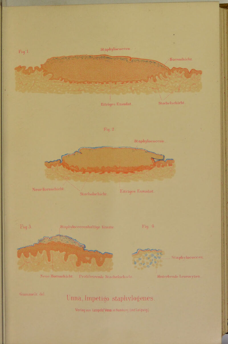 ijtapliylocopcen HornschicKl ßitriiji'.s Exsudat \, Sl/uhi-lsdiichl Staphylocopcen Neue HornB<‘hi<'ht MMch Exsudat. Gummi? U de] .. i nna, Impoligo stcipriylogenes. Verlaqvon Leopold Voss inHamlwn, (und Leipzig.)